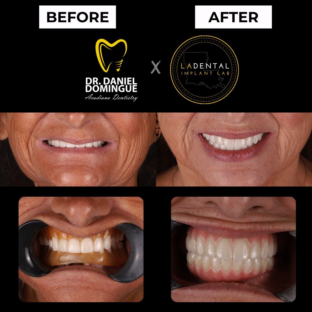 Traditional dentures can restore appearance, but when the bite is off and esthetics begin to decline, function and confidence often follow.

This patient presented with an unstable bite and poor coloration in her existing denture. While dentures can 