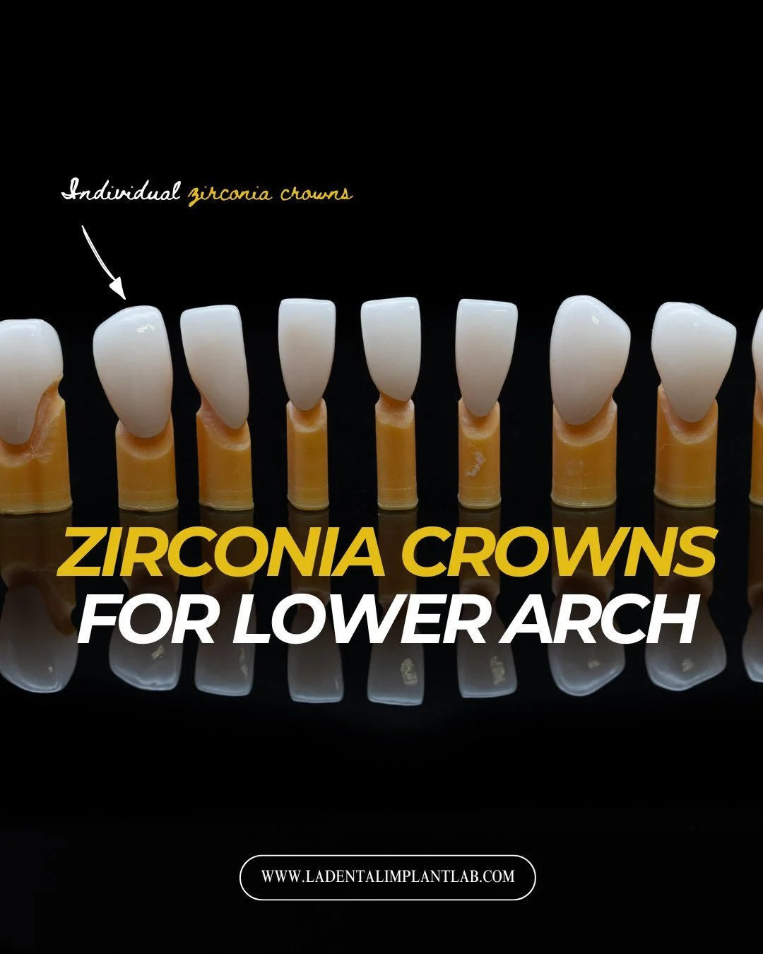Single units still require the same level of precision as full-arch cases.

This case features a full set of zirconia crowns placed on prepared teeth, designed to restore esthetics, function, and long-term durability. Proper prep design, material sel