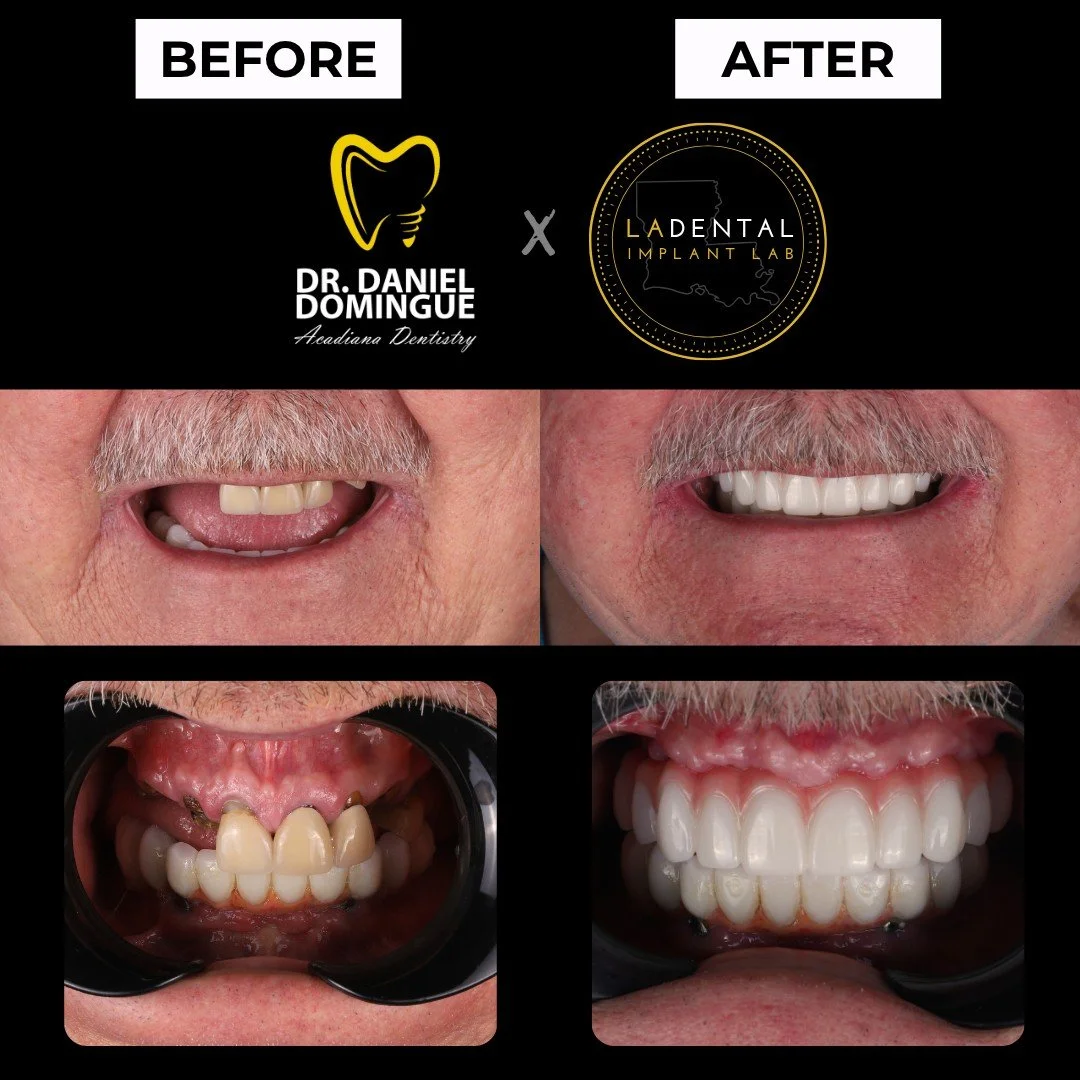 A full arch restoration is more than a cosmetic transformation. It is about rebuilding function, stability, and long-term oral health.

This patient initially presented with decay affecting multiple teeth. Over the course of treatment, several teeth 