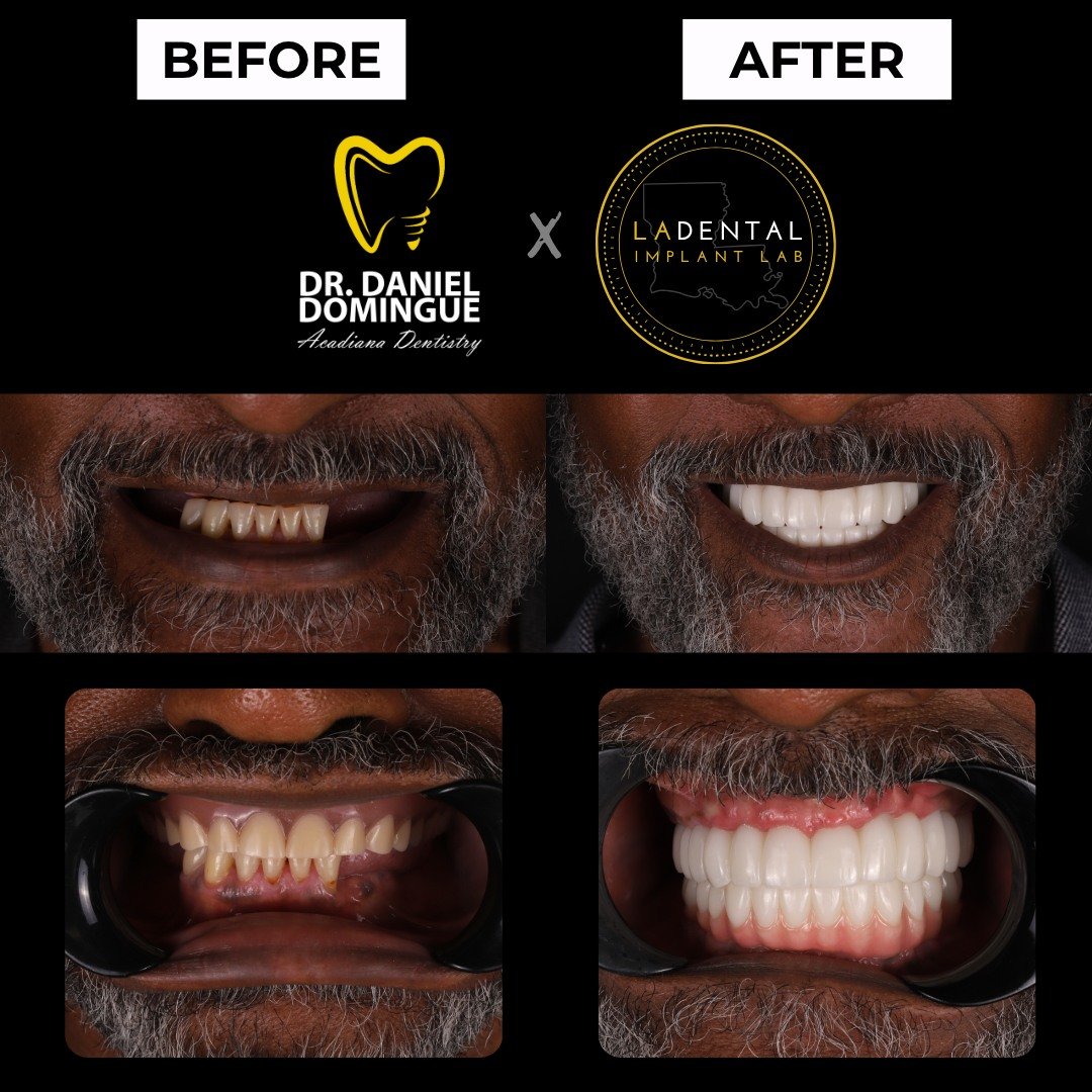 This patient came to our office with an upper denture and only five remaining teeth on the lower arch. While implant-supported dentures were discussed, the patient wanted a solution that looked, felt, and functioned more like natural teeth.

With str