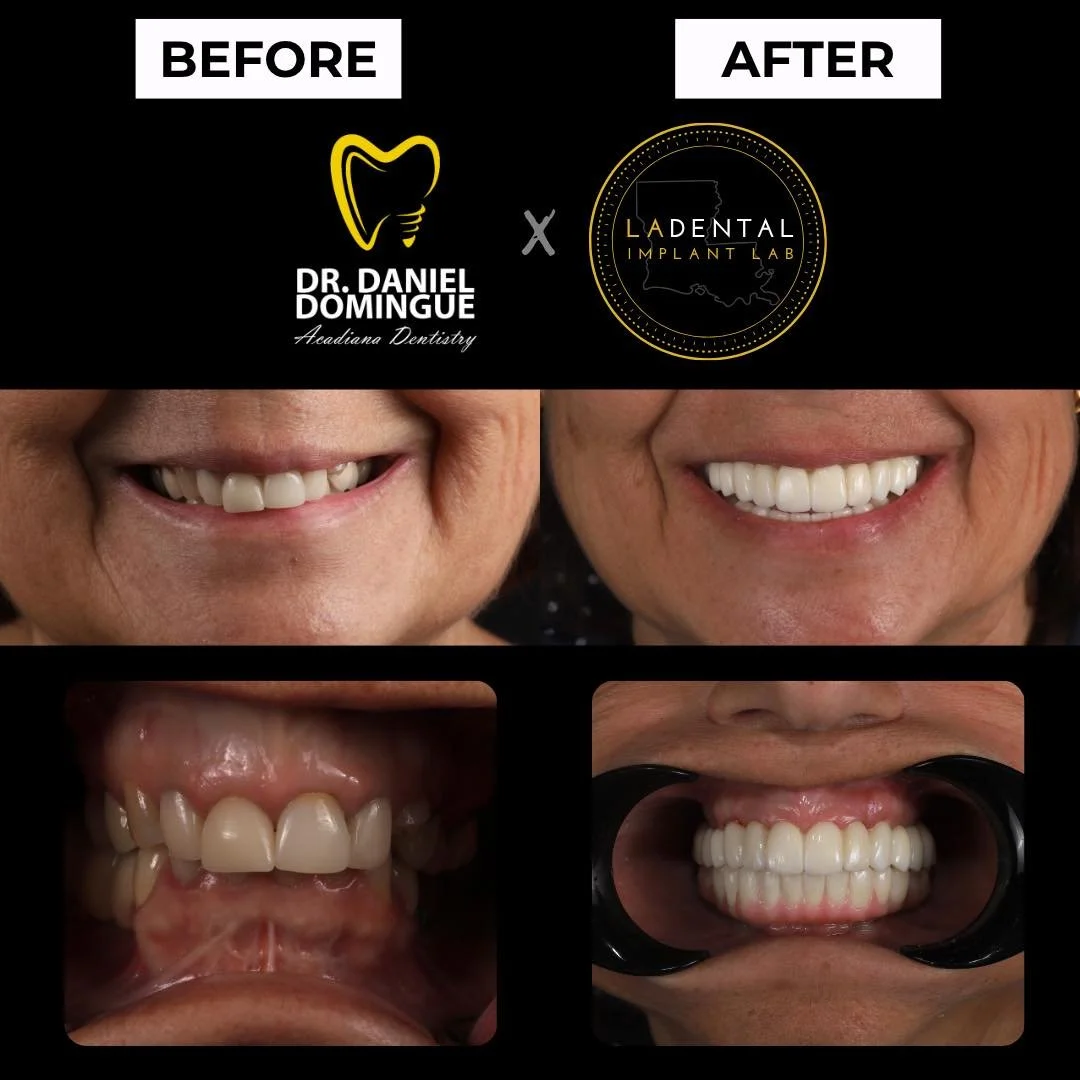 A complete smile transformation designed for long-term stability and function.

This patient presented with a collapsed bite, multiple failing restorations, active decay, and a history of extensive dental work that was no longer making her happy. Aft