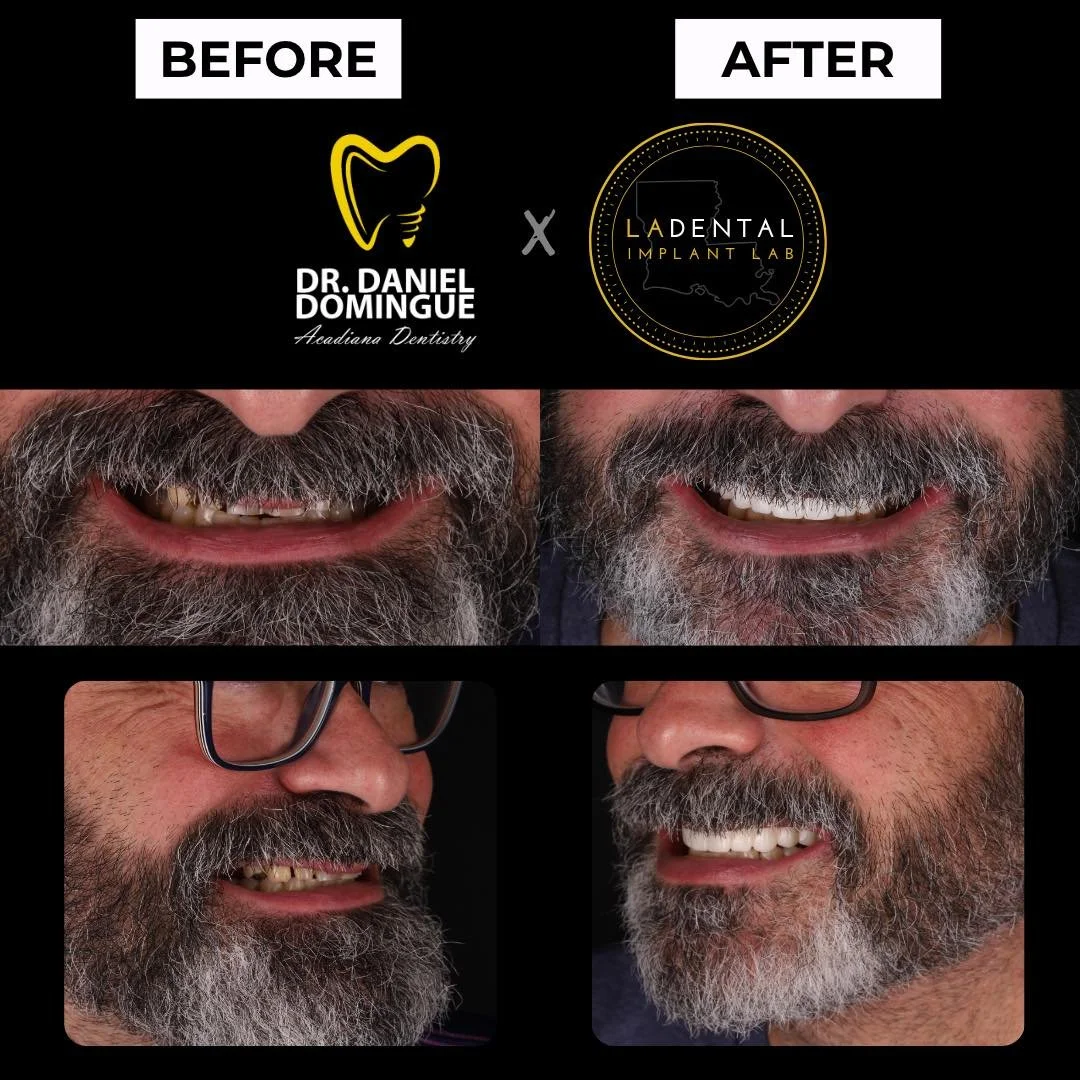 When severe bone loss and failing teeth begin to affect both function and confidence, a full-arch implant solution can create a life-changing transformation. This patient presented with multiple missing teeth and advanced bone regression in the upper