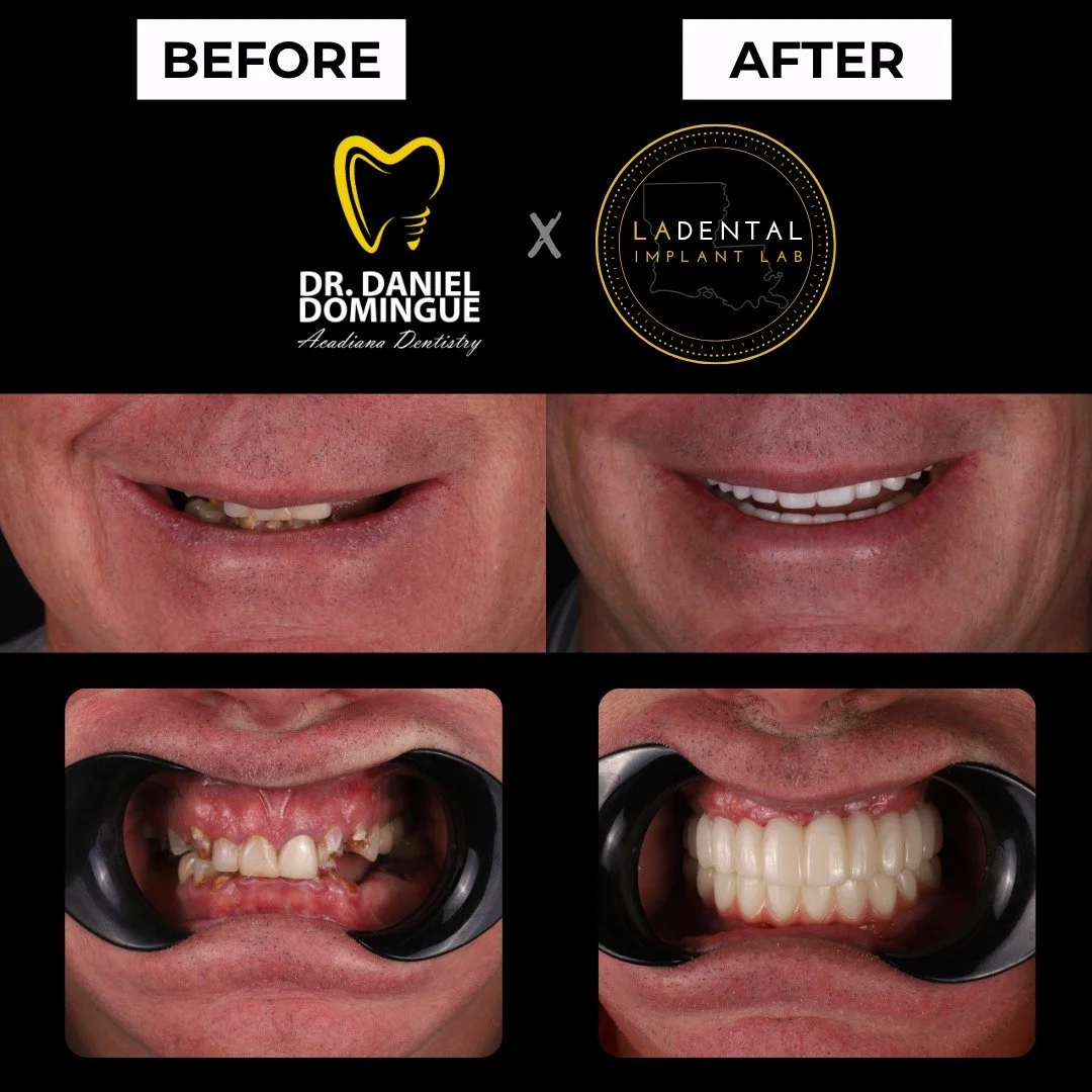 Years of dental work can sometimes reach a point where additional repairs no longer provide a predictable long-term solution.

This patient had undergone numerous restorative treatments, including fillings and root canals, but continued to experience