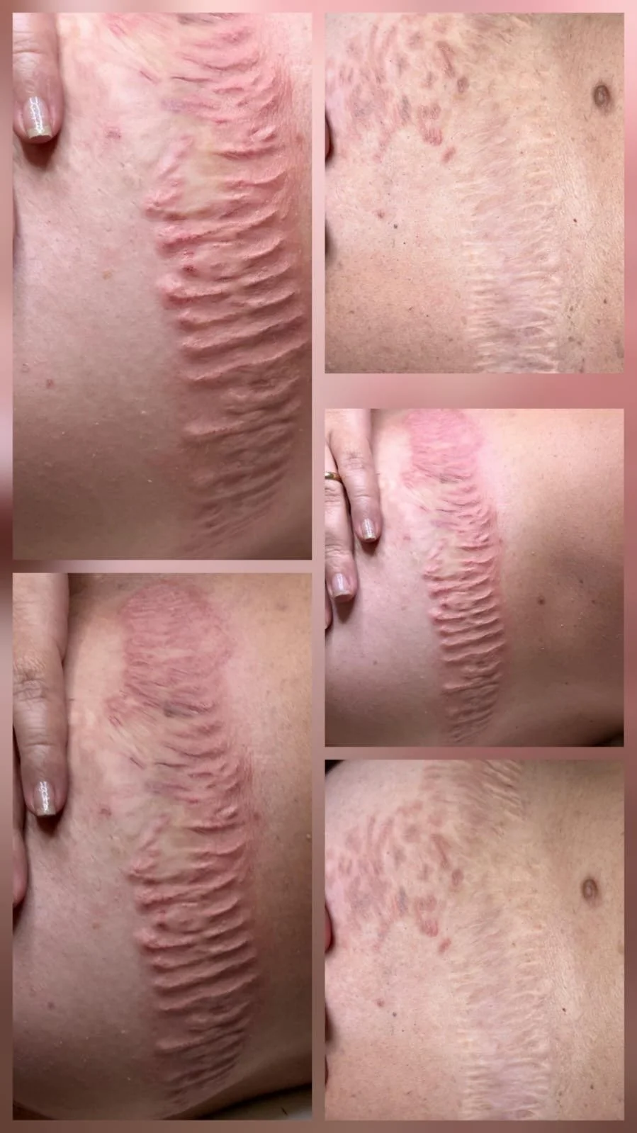 Camouflage avanzato di cicatrici e discromie