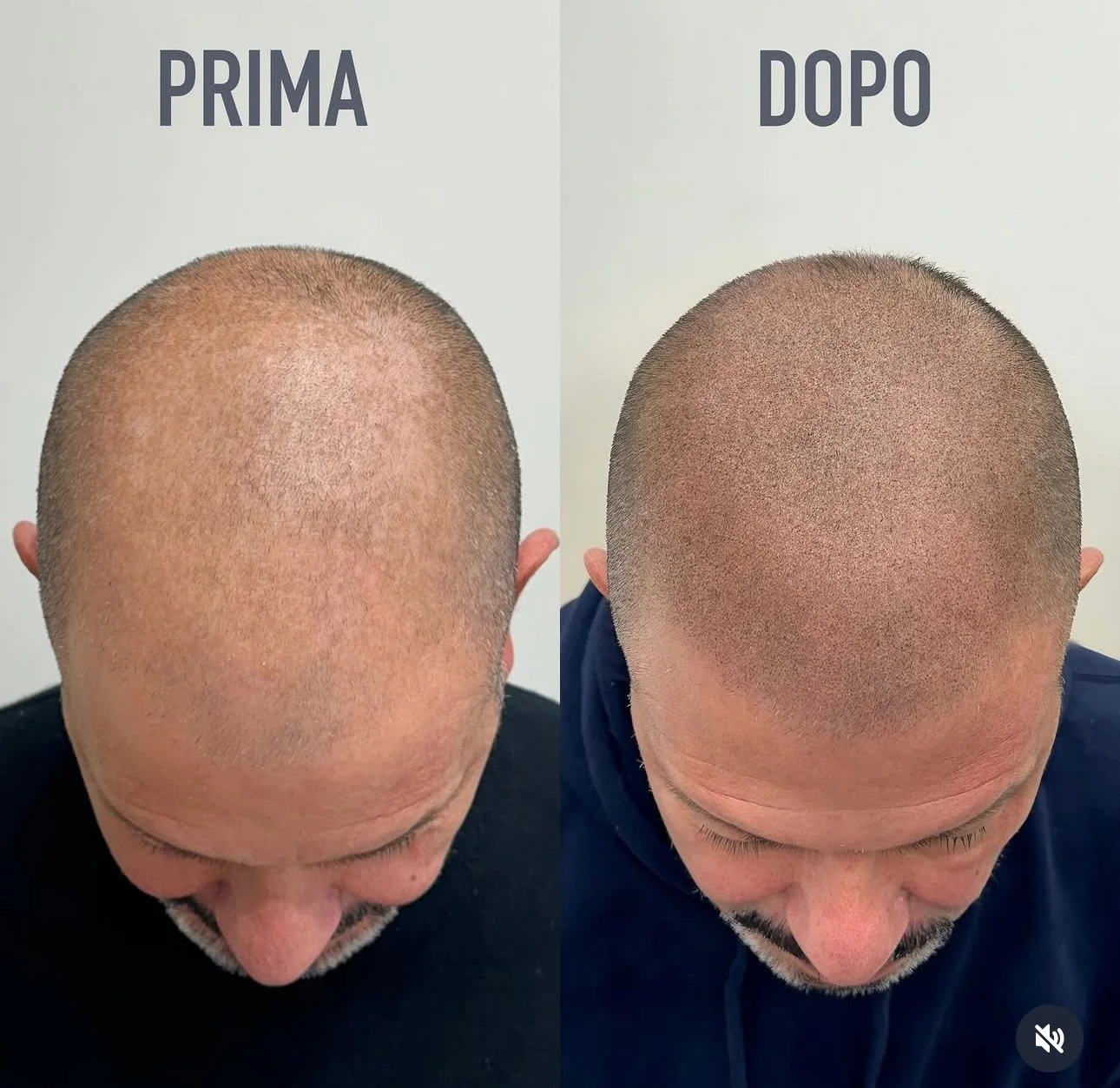 Tricopigmentazione Effetto Rasato ad Alta Definizione