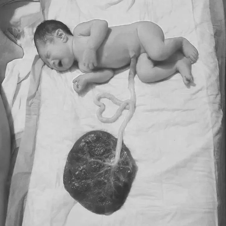 Newborn baby lying on a hospital bed with an umbilical cord attached to a large placenta.