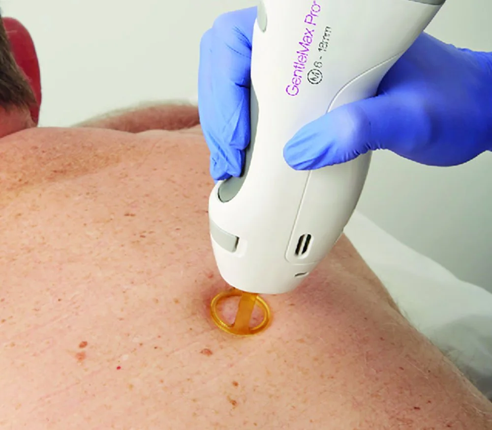 Person receiving a dermatological facial treatment with a handheld device on their chest.