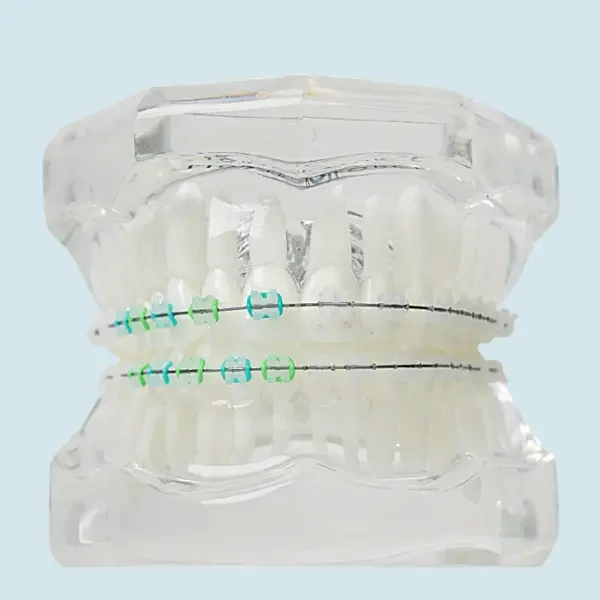 LightForce clear braces orthodontic treatment close up