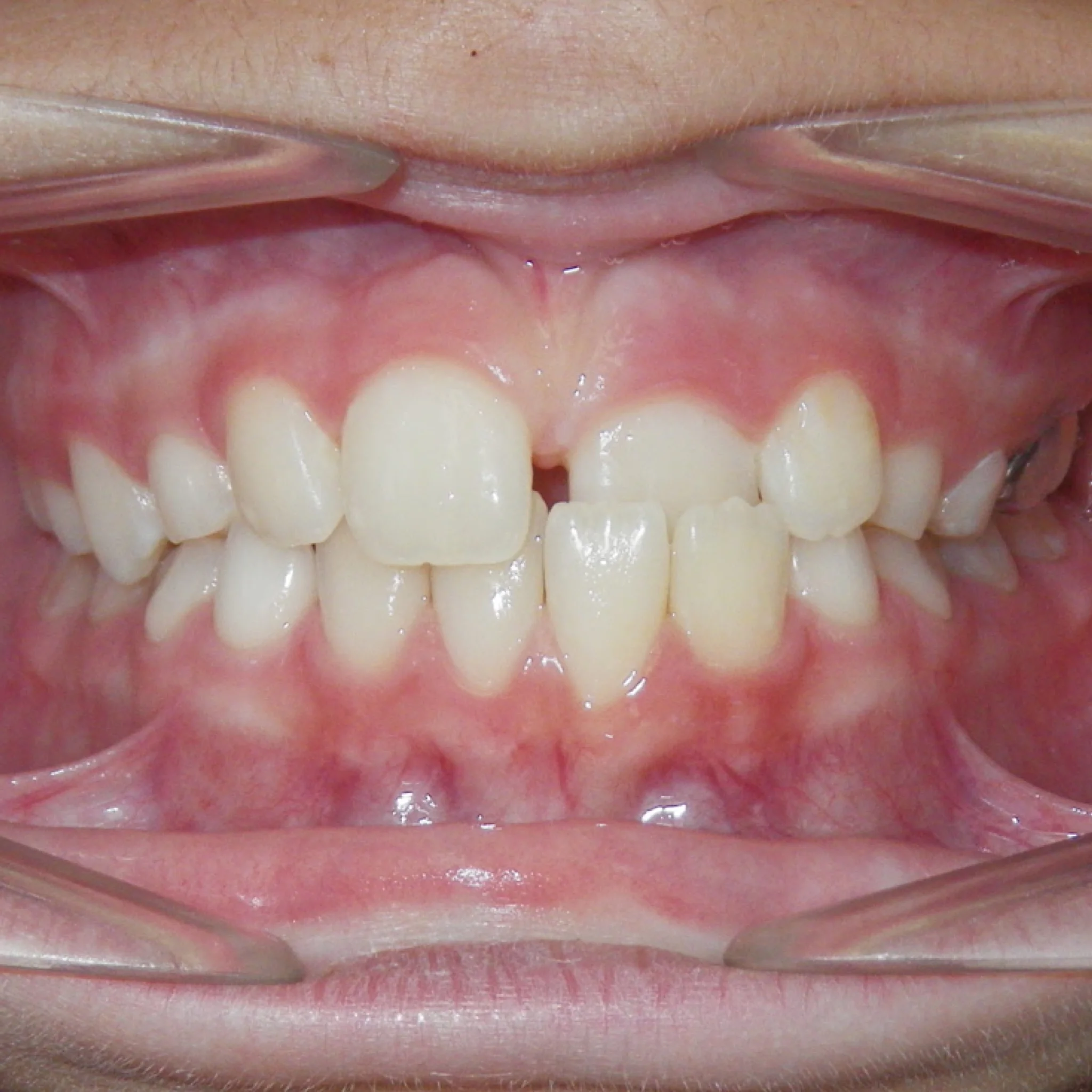 Anterior Crossbite