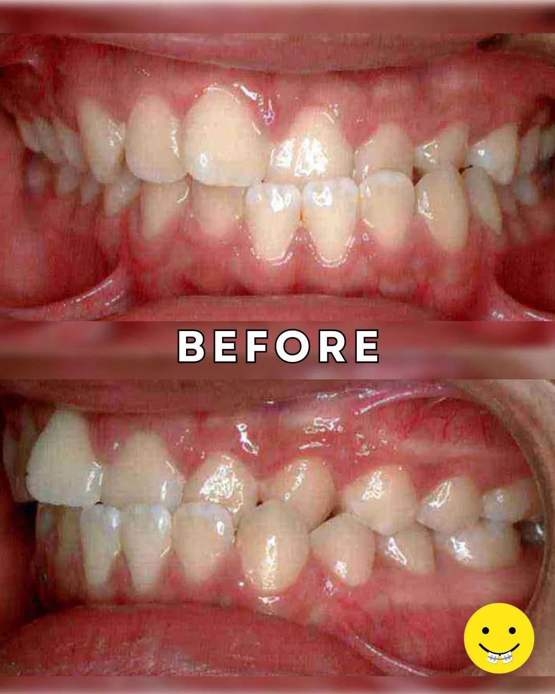 A beautiful transformation and an even brighter smile!💛

#BracesOff #SmileGlowUp #before&amp;after #perfectsmile #drdouglasdrsean