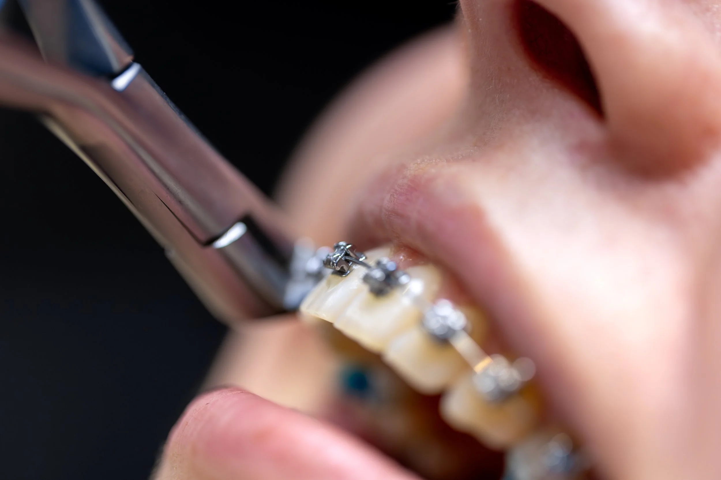 Close-up of a person's mouth with braces on their teeth, with an orthodontist using a dental tool near the braces.