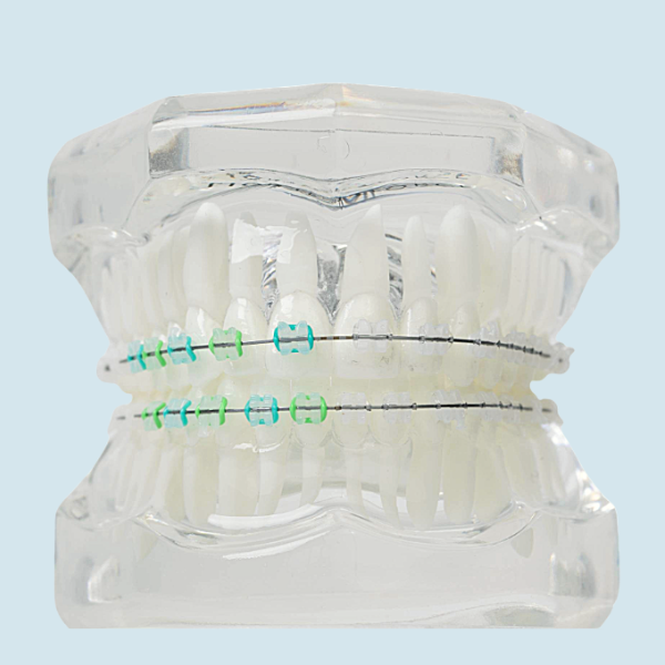 LightForce clear braces orthodontic treatment close up