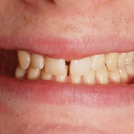 Close-up of a person's mouth showing misaligned upper and lower teeth, some teeth are crooked and uneven.