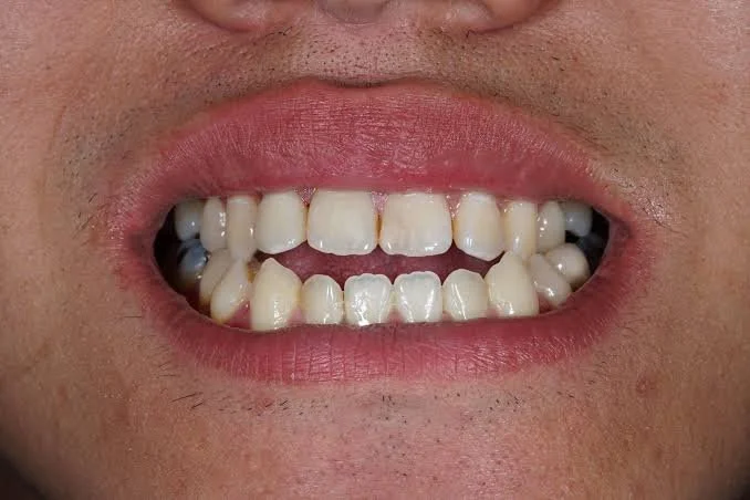 Close-up of a person's mouth showing misaligned and chipped teeth with some gaps.