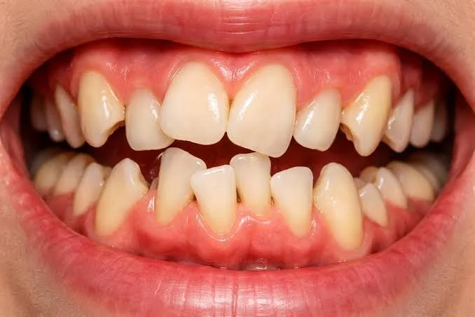 Close-up of a person's mouth showing misaligned and crooked teeth with gaps and uneven spacing.