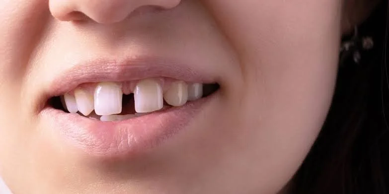 Close-up of a person's mouth showing missing, crooked, and misaligned front teeth.
