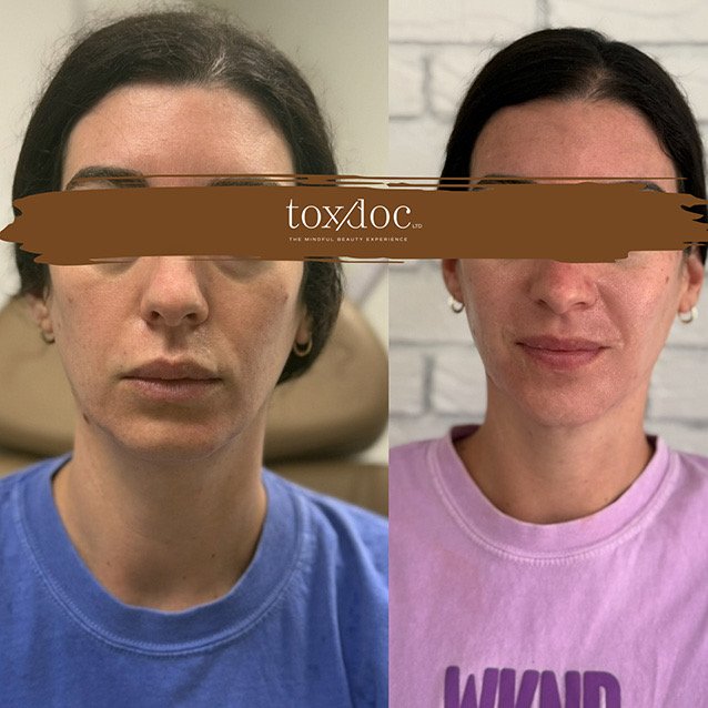 The Fountain of Youth: Full-face rejuvenation with Sculptra to restore structure, skin quality, and long-term collagen support.