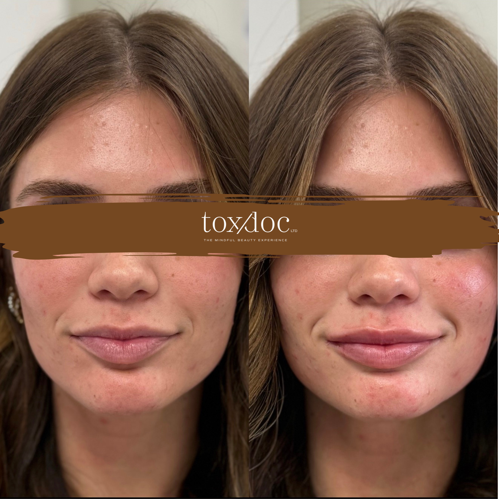 Subtle & Sultry: Subtle lip enhancement with submental crease refinement designed to support lower-face balance and feminine projection.