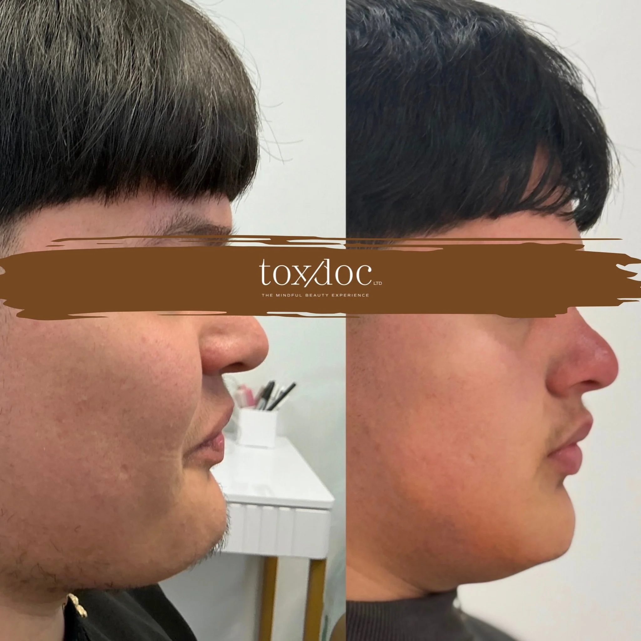 The Sculpted Profile: Liquid rhinoplasty focused on non-surgical nasal contouring and profile refinement.