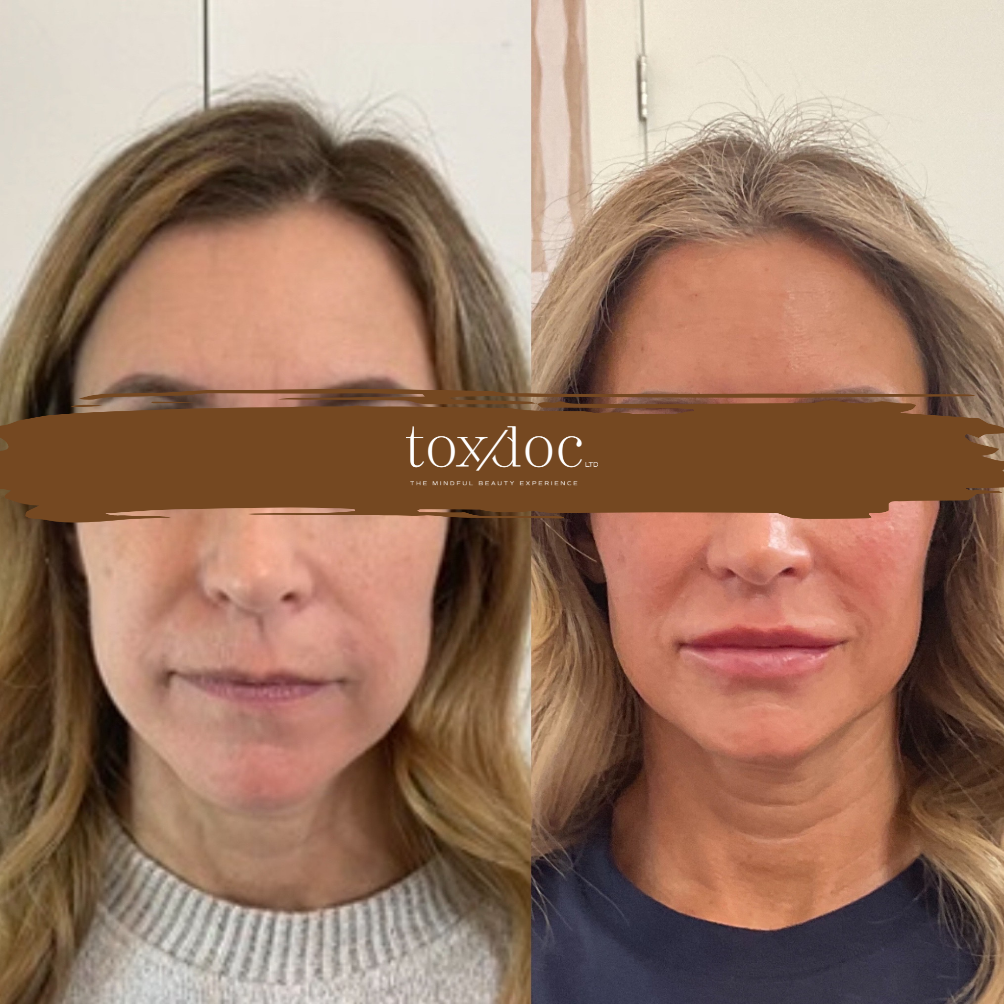 The Structural Lift: Comprehensive facial balancing using full-face neuromodulation, temple and midface restoration, prejowl sulcus correction, jawline refinement, submental crease softening, and lip enhancement.