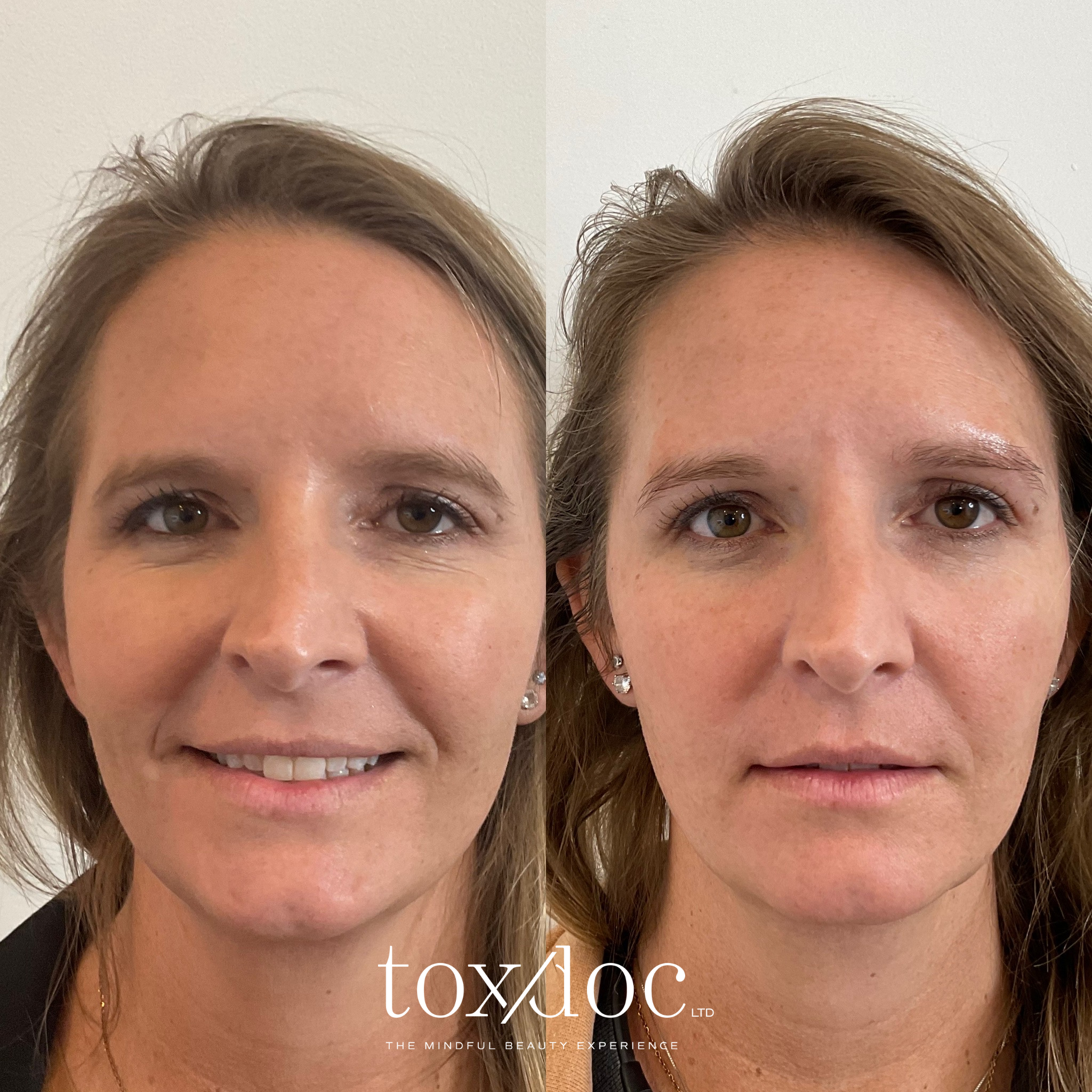 The Elevated Brow: Subtle brow elevation with strategic neuromodulation and temple restoration for a refreshed, rested appearance.
