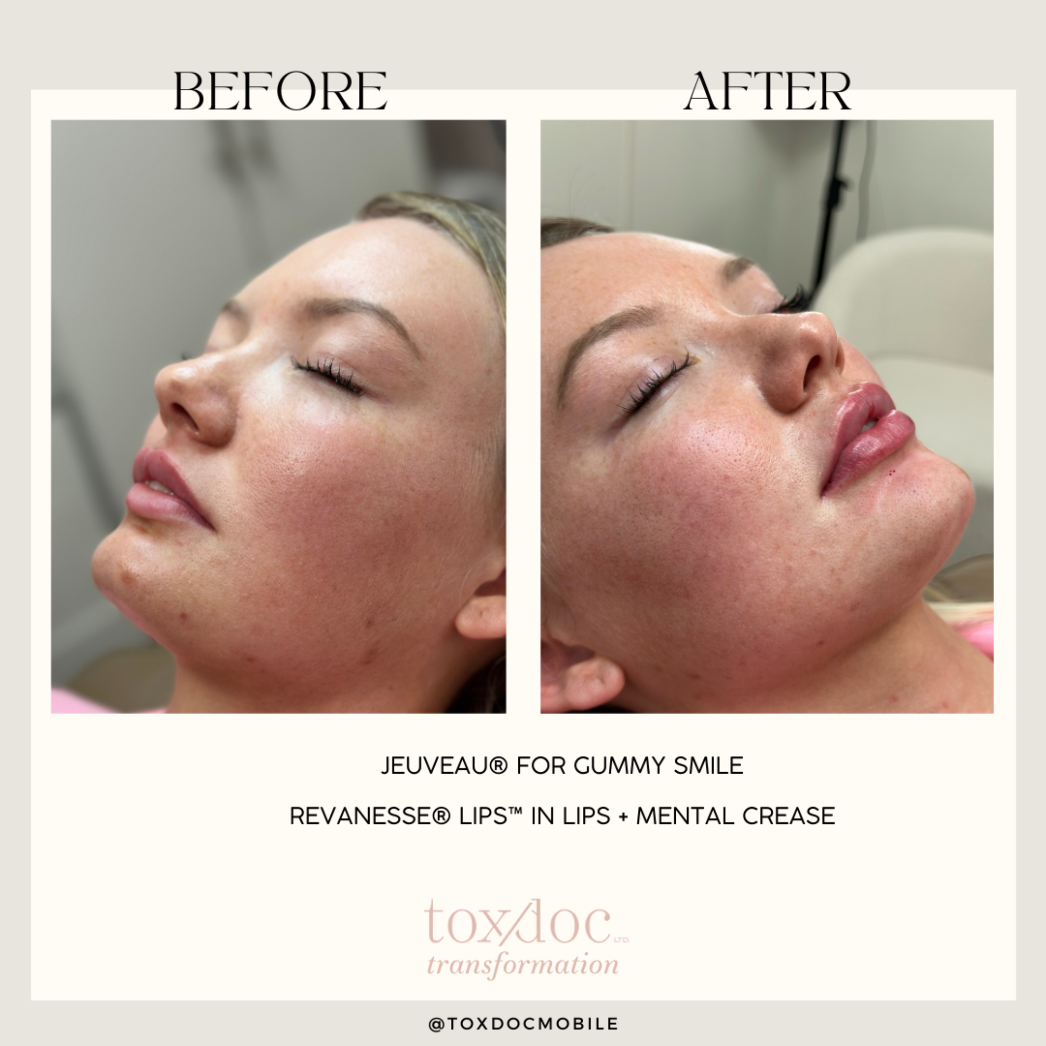 The Perfect Pout: Lip enhancement paired with submental crease correction to improve lower-face balance and projection.