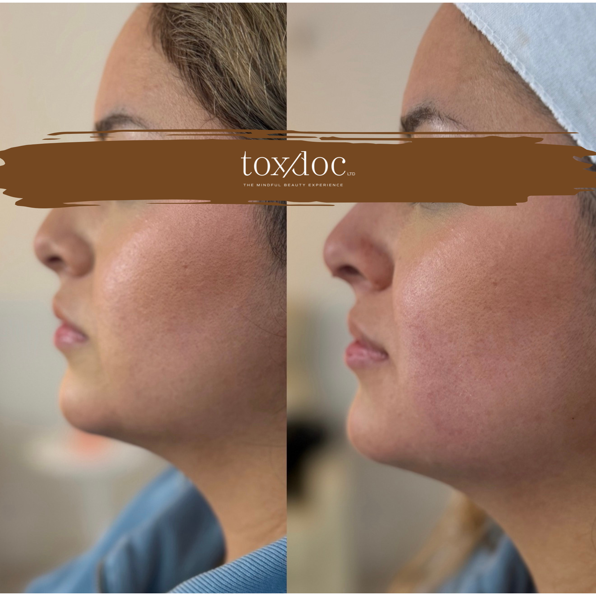The Sculpted Profile: Liquid rhinoplasty focused on non-surgical nasal contouring and profile refinement.
