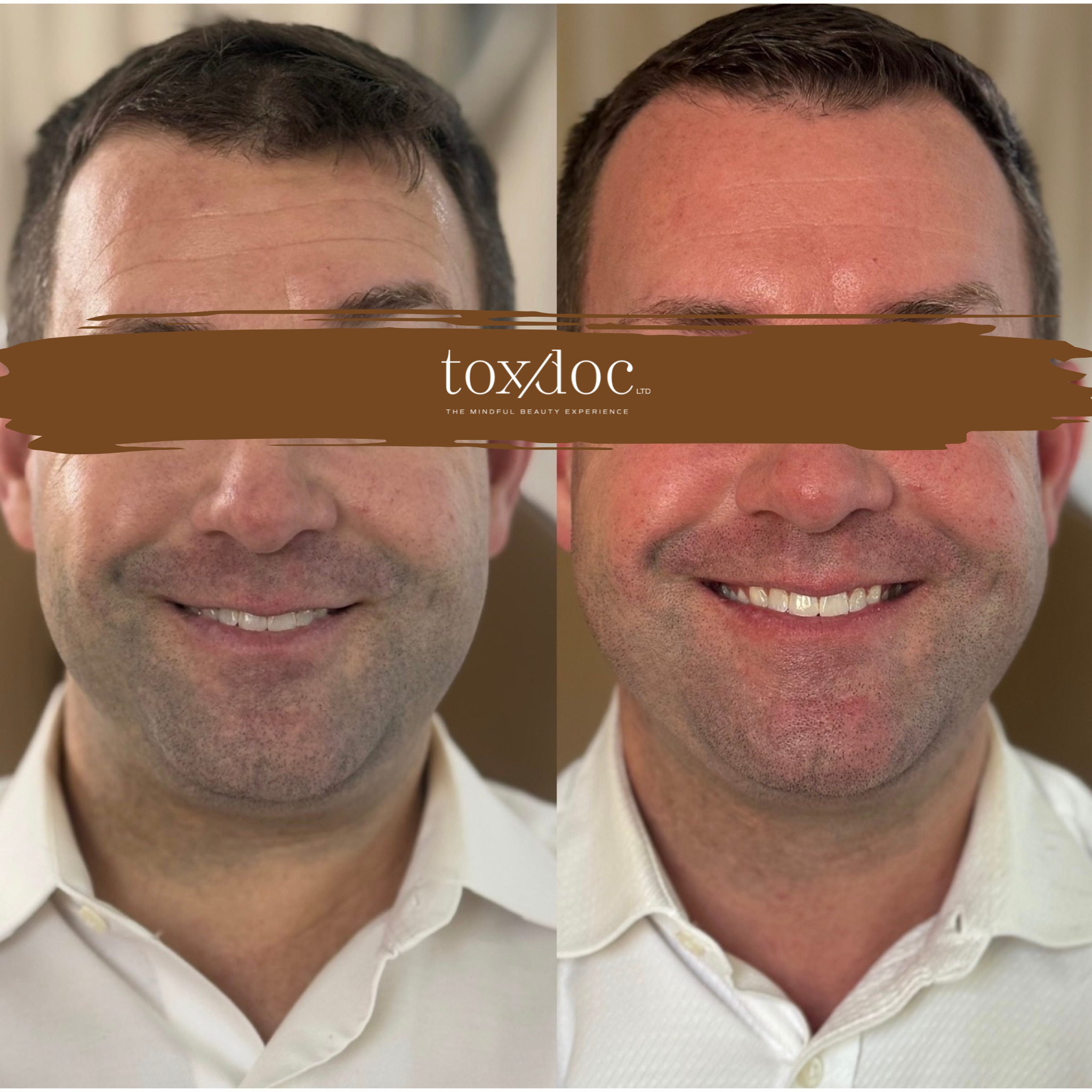 The Executive Refresh: “Brotox” designed for subtle masculine rejuvenation targeting the forehead, glabella (“elevens”), and crow’s feet while maintaining natural expression.