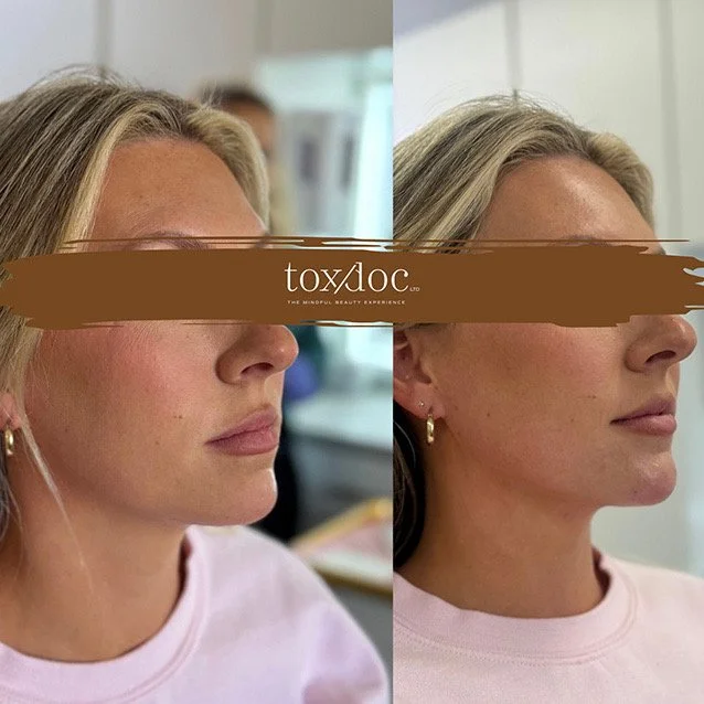 Balanced: High level facial analysis & treatment plan based on anatomy which entailed chin tox, chin filler, Nefertiti neck lift, and midface structural support for effortless overall harmony & facial balance.