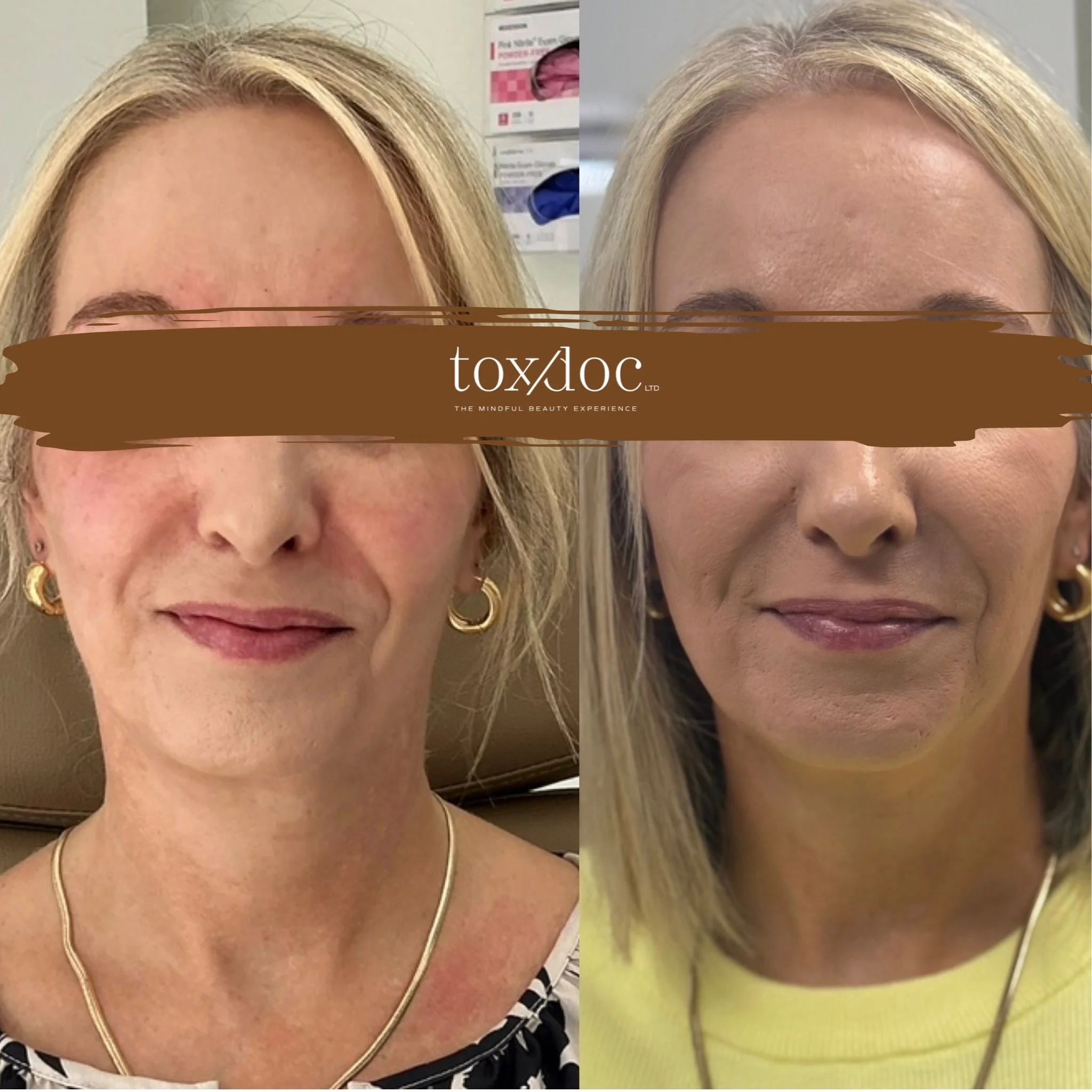 Balanced: High level facial analysis & treatment plan based on anatomy which entailed chin tox, chin filler, Nefertiti neck lift, and midface structural support for effortless overall harmony & facial balance.