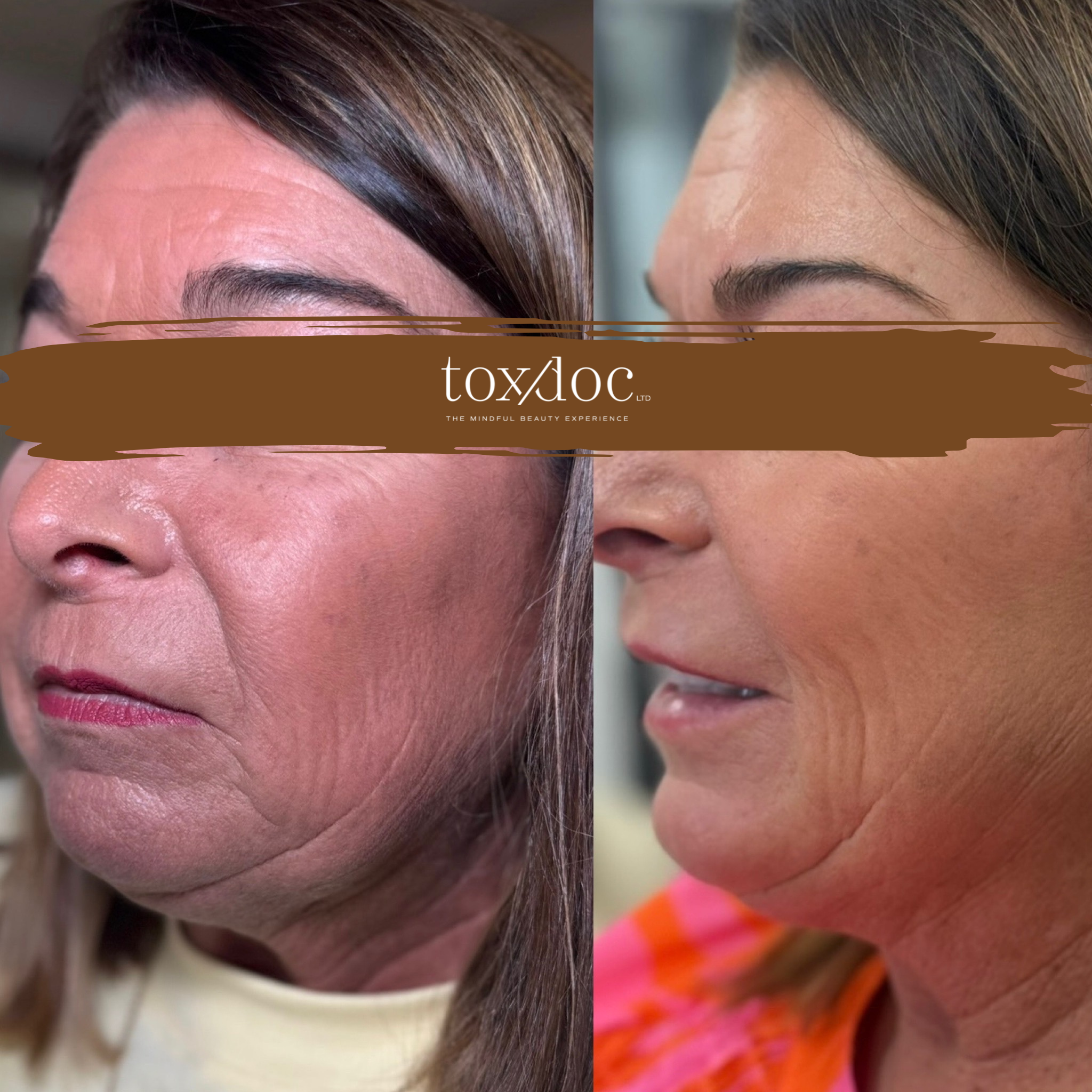 The Skin Rebuild: Light CO2 laser resurfacing rejuvenation to improve texture, tone, fine lines, and overall skin quality with minimal downtime.