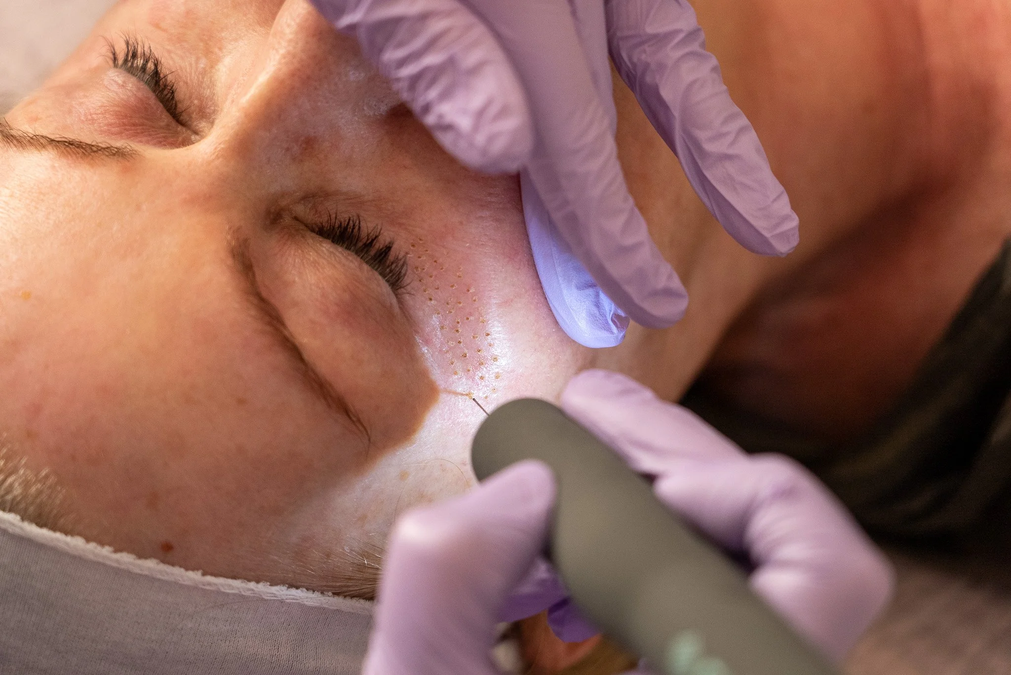 A person receiving a facial treatment, with a gloved hand performing the procedure.