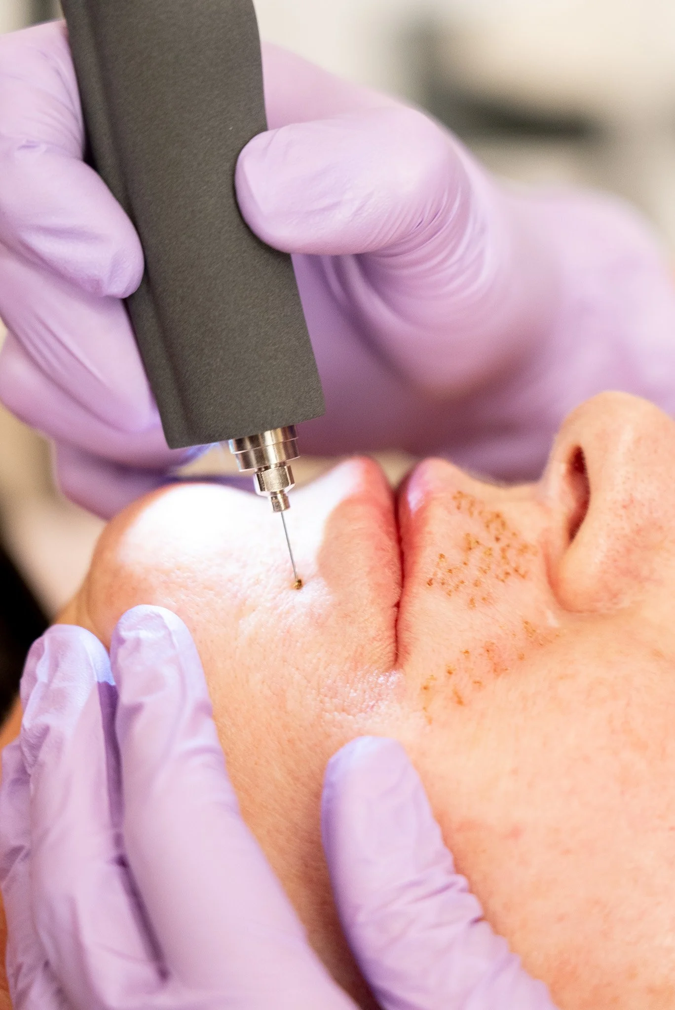 Close-up of a person receiving a tattoo needle injection on their skin, with a hand wearing a purple glove holding the needle apparatus.