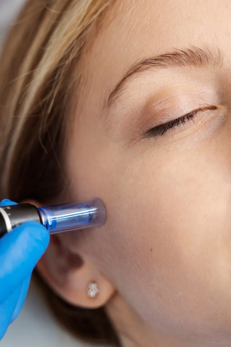 Close-up of a woman receiving a cosmetic injection near her cheek, with a healthcare worker wearing blue gloves holding a syringe close to her face.