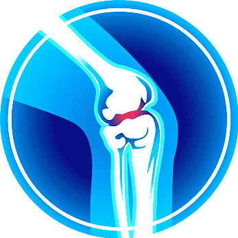 Illustration of a human knee joint with a ligament tear indicated by a red line.