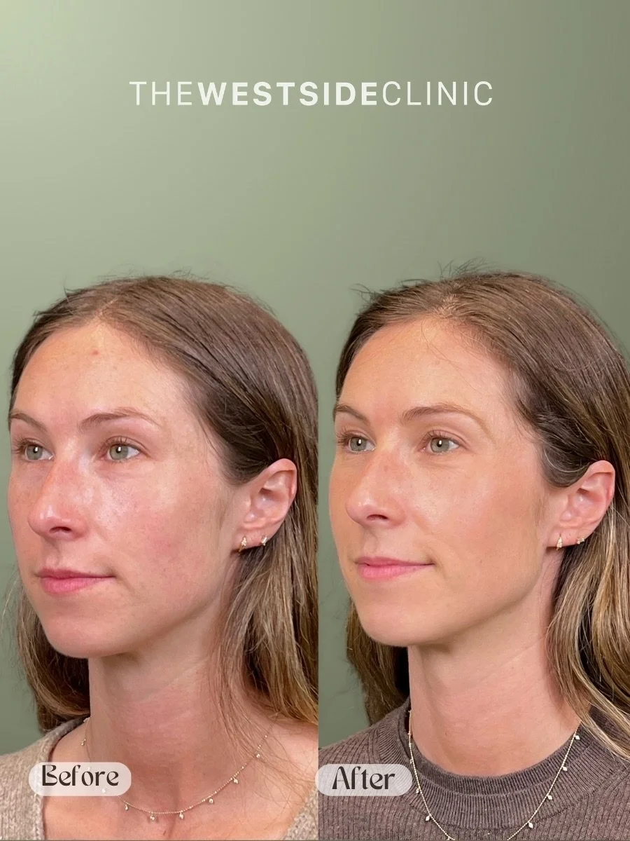 Light up the room with The BBL/Moxi series.  This stacked series will reduce and eliminate pigment + redness, minimize pores, improve the integrity of the skin, and leave you looking polished and glowing 
I mean, we could go on&hellip;but the picture