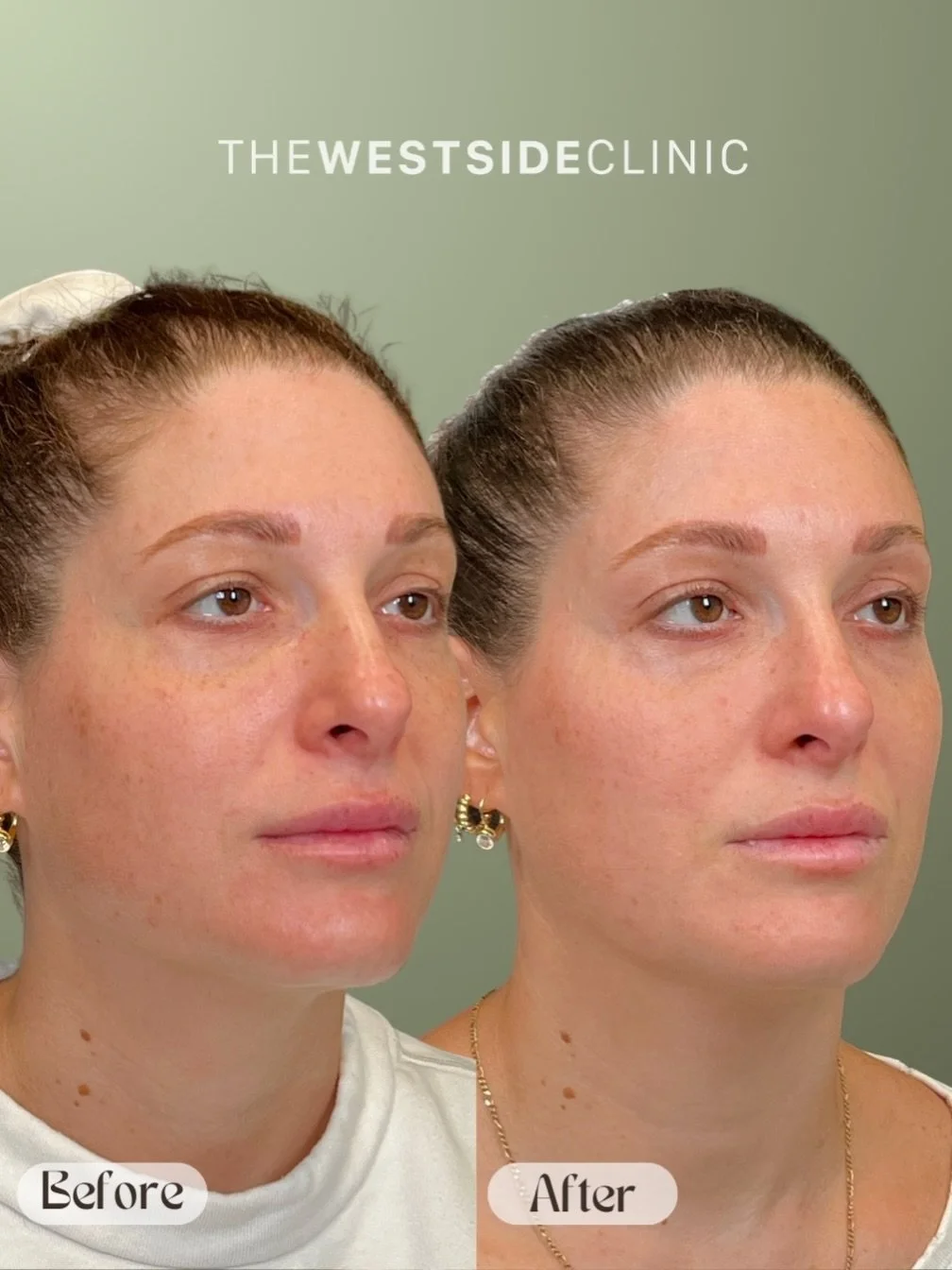 Keep the summer memories, erase the summer skin damage! 
The BBL series targets hyperpigmentation (eg. age and sun damage/ spots), generalized redness (such as rosacea) and broken blood vessels, while improving the integrity of the skin, minimizing p
