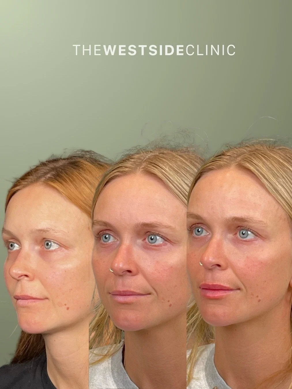 💋This gorgeous hunny came in for a consultation on her lips, which had been previously filled elsewhere several times. We found that some of the filler had migrated above her lip, causing the philtrum to appear longer, and the upper lip to invert, b