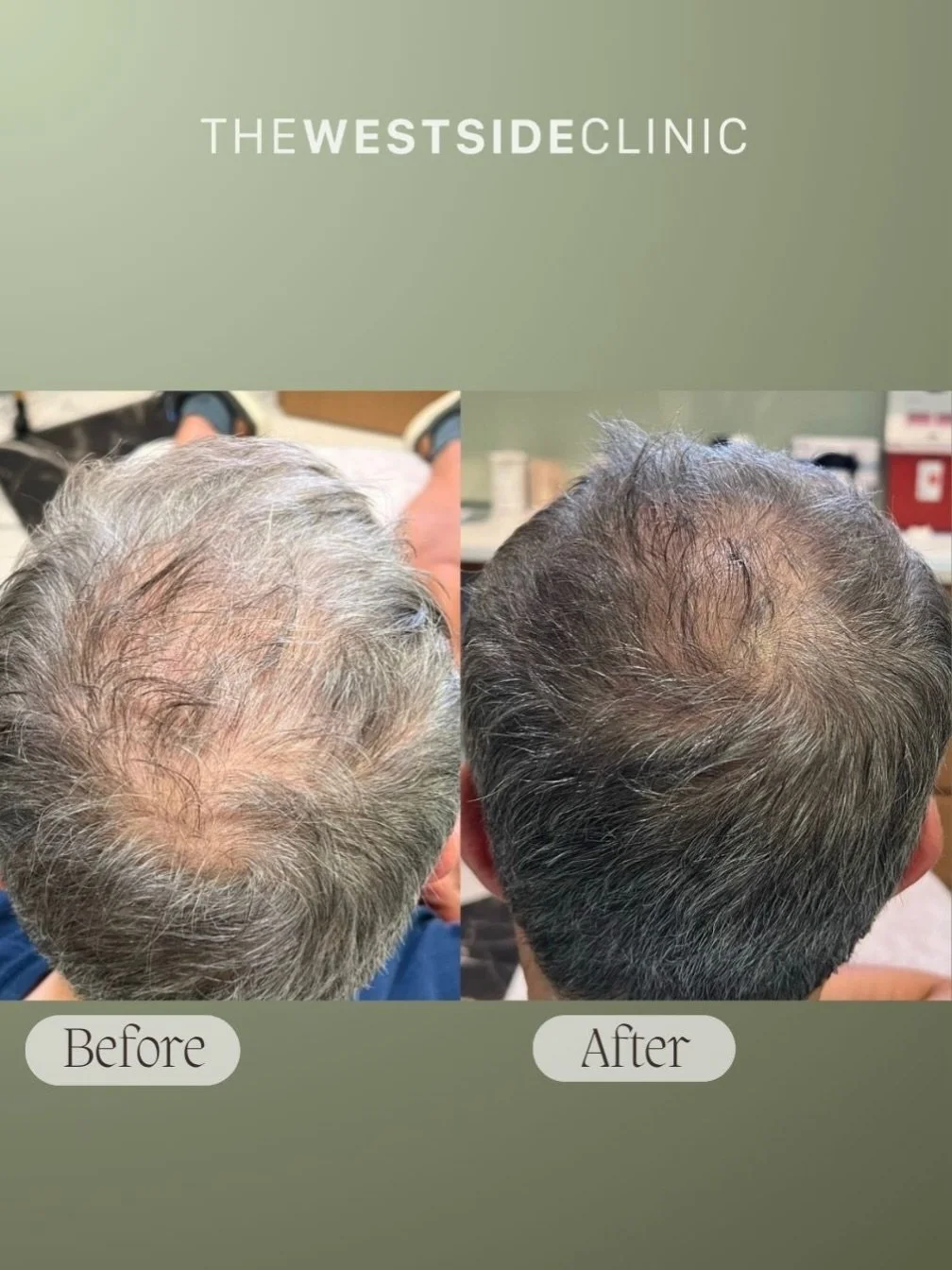 Take advantage of our August specials before they end ⏰

PDGF for hair growth 💁🏻&zwj;♂️ 

- Photos taken 6mos after 1 treatment

. . . 

Follow link in bio for booking 🔗🔗 

Team:
👩🏼&zwj;⚕️ Hannah, PA-C&nbsp;@hannah_hunt_pa
👩🏼&zwj;⚕️ Taylor, R