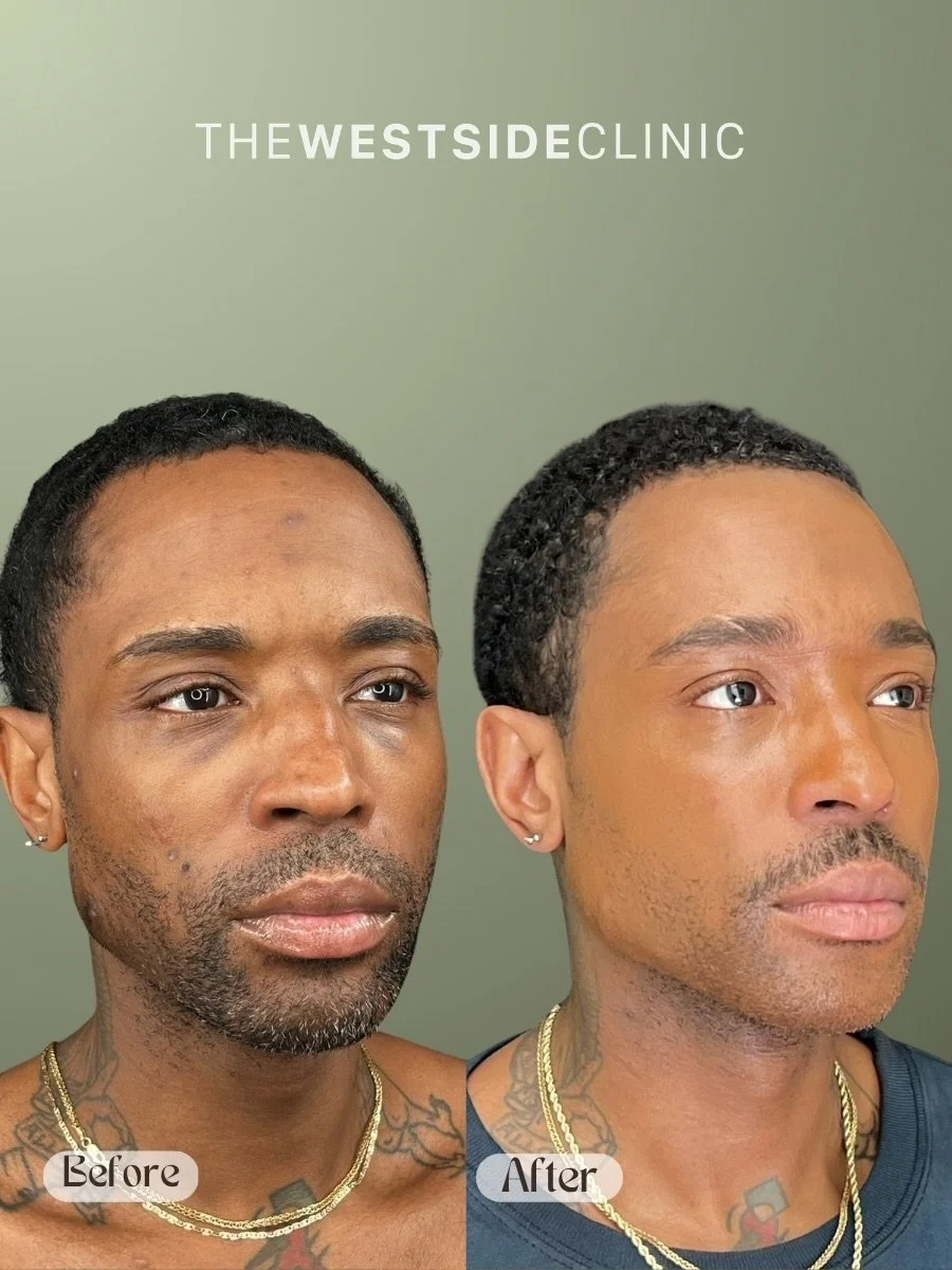 A subtle shift&hellip;that can move mountains 😍🤤

&bull; PDGF to soften the under eye junction and midface 
&bull; HA filler and biostimulator to support midface and sharpen the jawline 
&bull; Rx and medical grade topicals to improve skin texture 