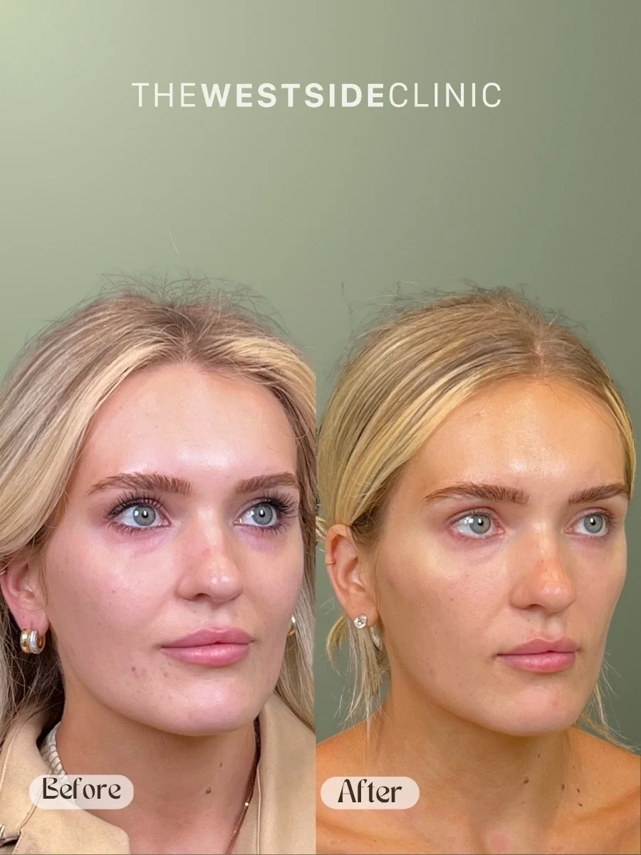 💉✨ PDGF to the under eyes to reverse signs of summer parenting 

Refresh under eyes with Ariessence PDGF, these gorgeous results are after just one treatment!

Photos taken 8 weeks after treatment.

. . . 

Follow link in bio for booking 🔗🔗 

Team