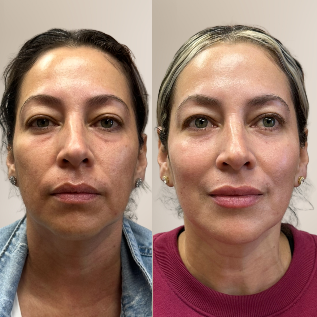 before-and-after-facial-balancing.png