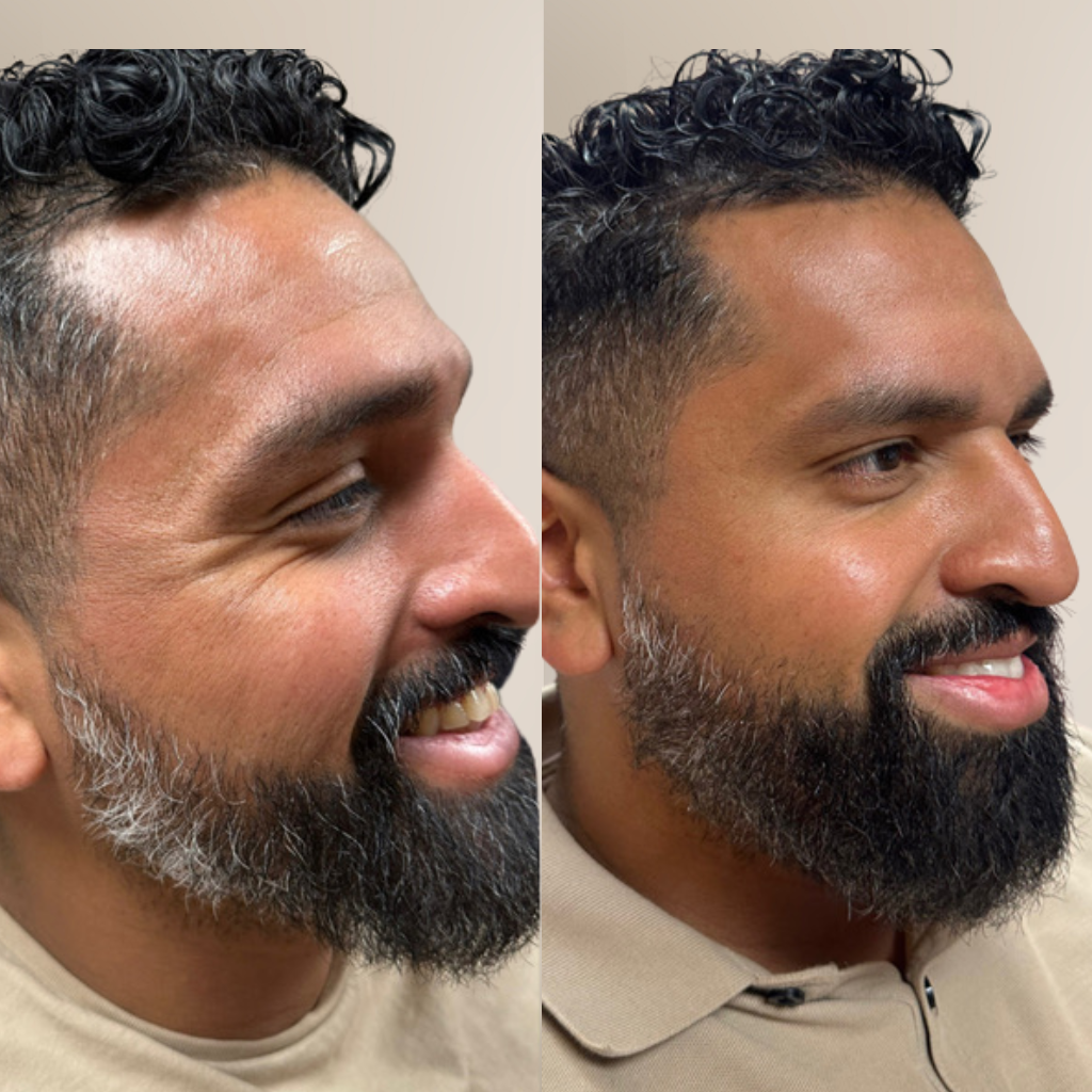 before-and-after-male-botox-crows-feet-side-profile.png