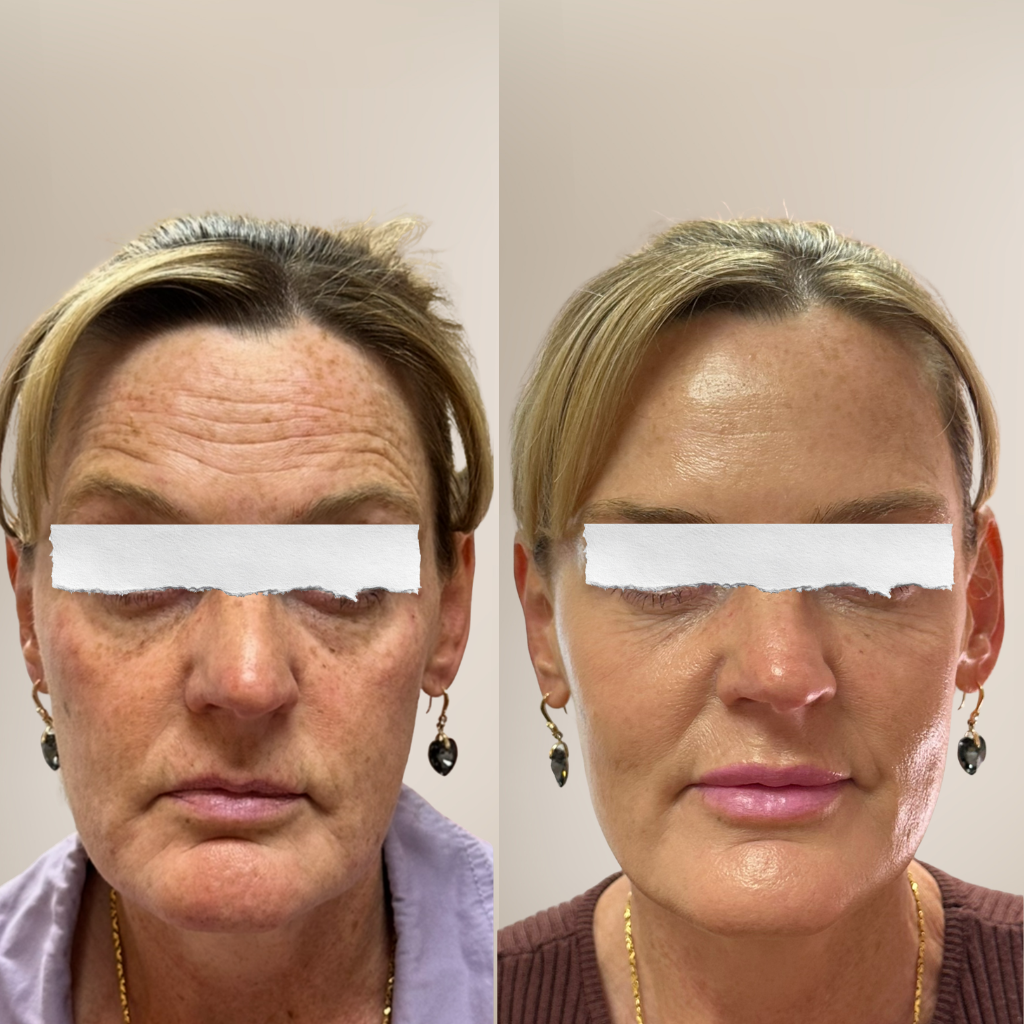 before-and-after-under-eye-prp-cheek-filler-chin-filler-medical-grade-skincare.png