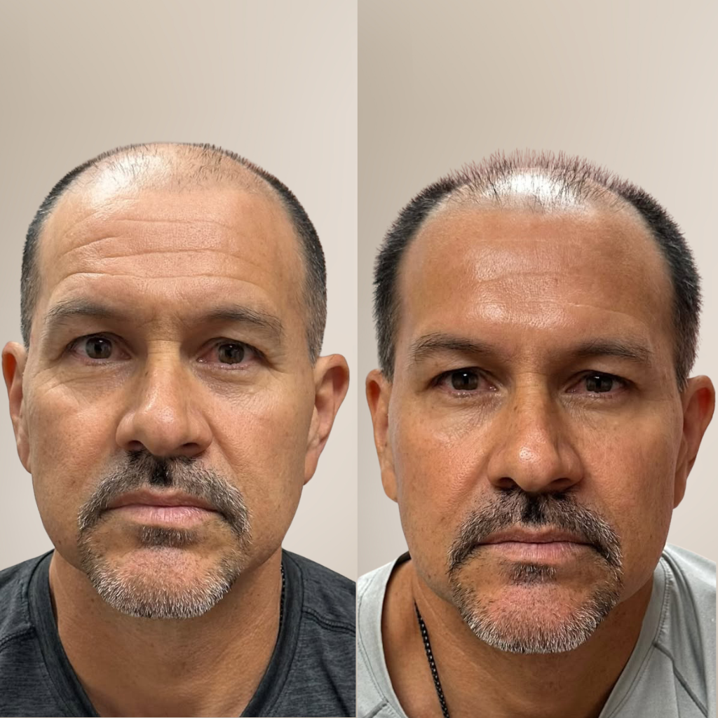 before-and-after-male-botox-forehead-front-view.png