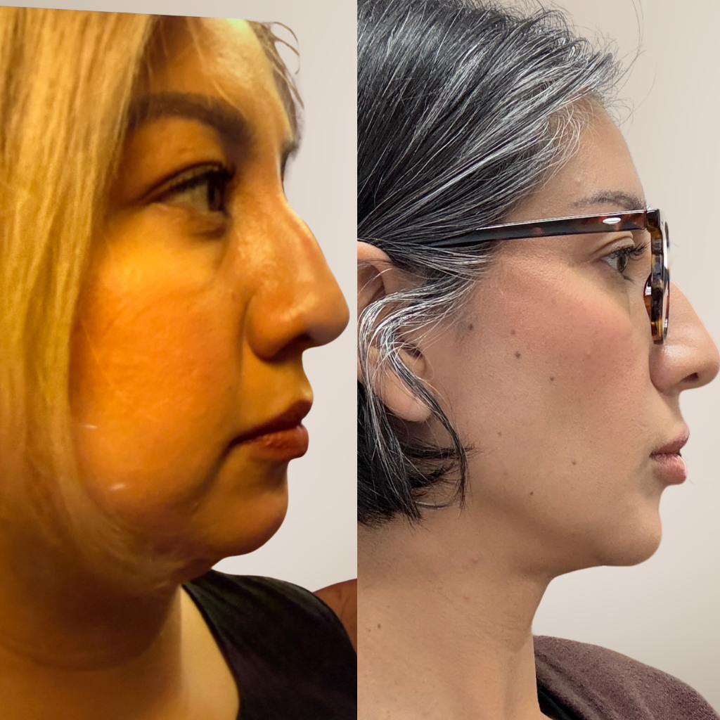 before-and-after-facial-balancing-morpheus8-side-profile.png