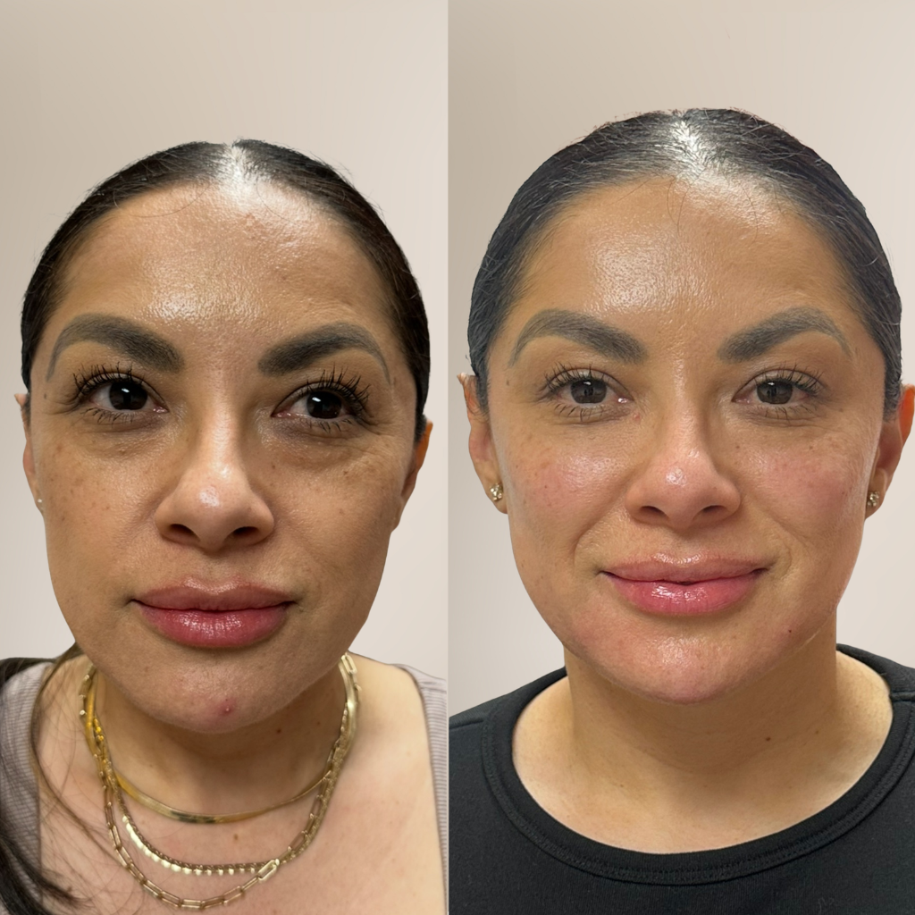 before-and-after-under-eye-prp-front-view.png