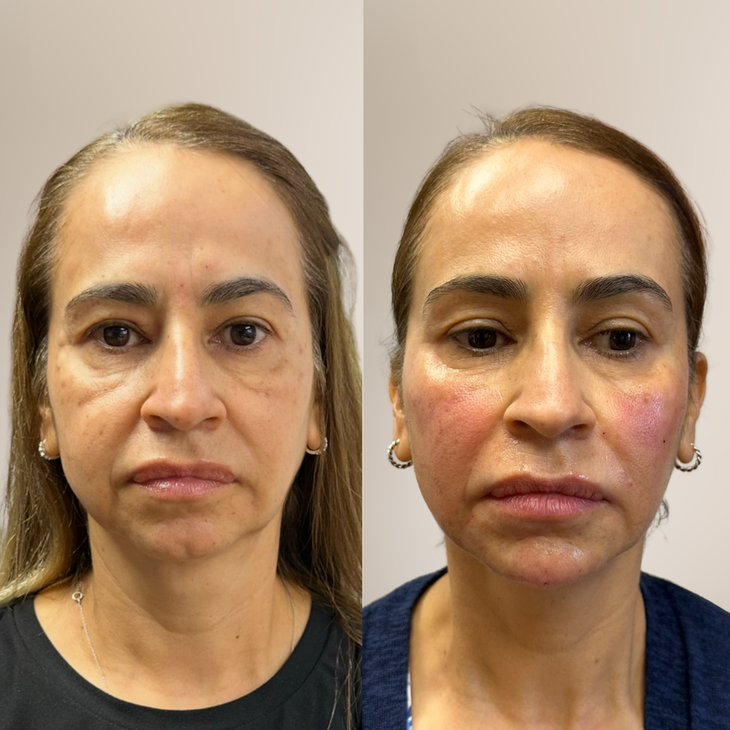 before-and-after-facial-balancing-morpheus8-front-profile.png