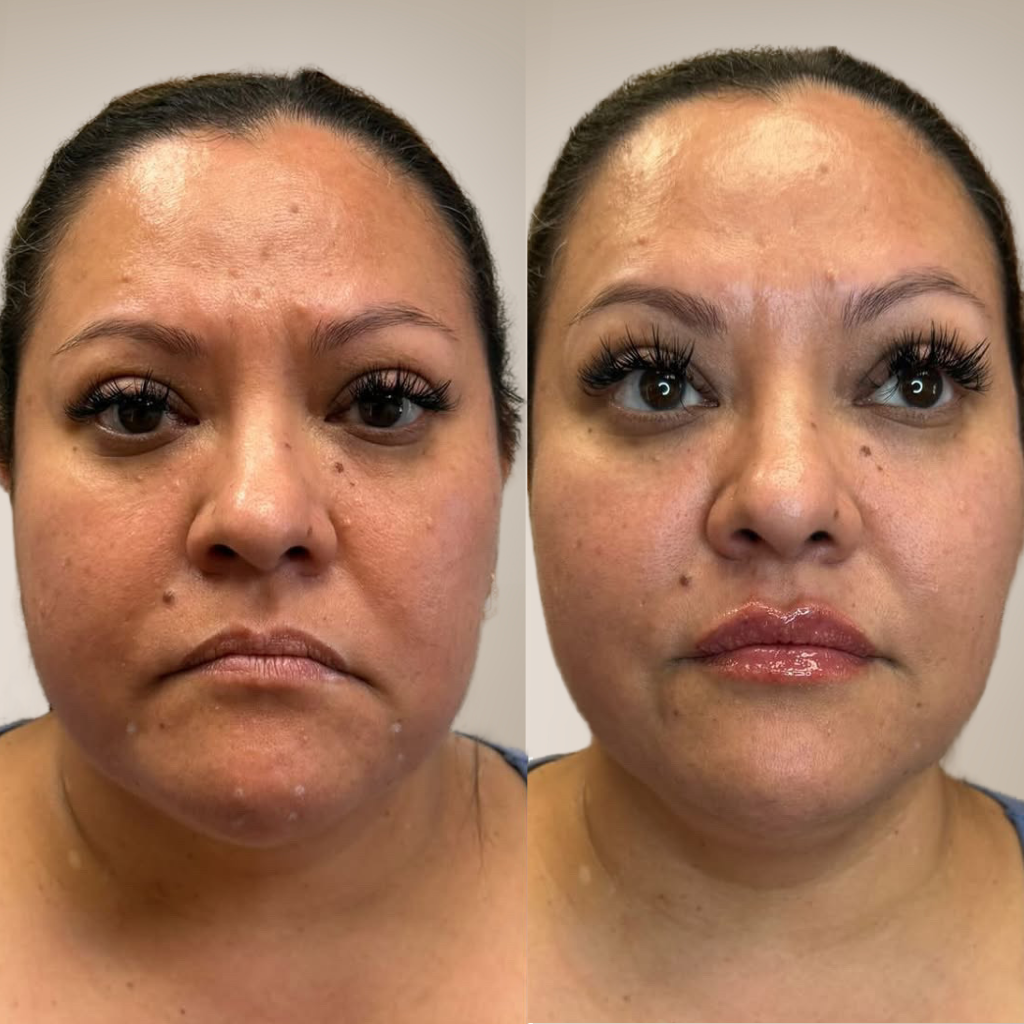 before-and-after-natural-lip-filler-for-downturned-smile-front-profile.png