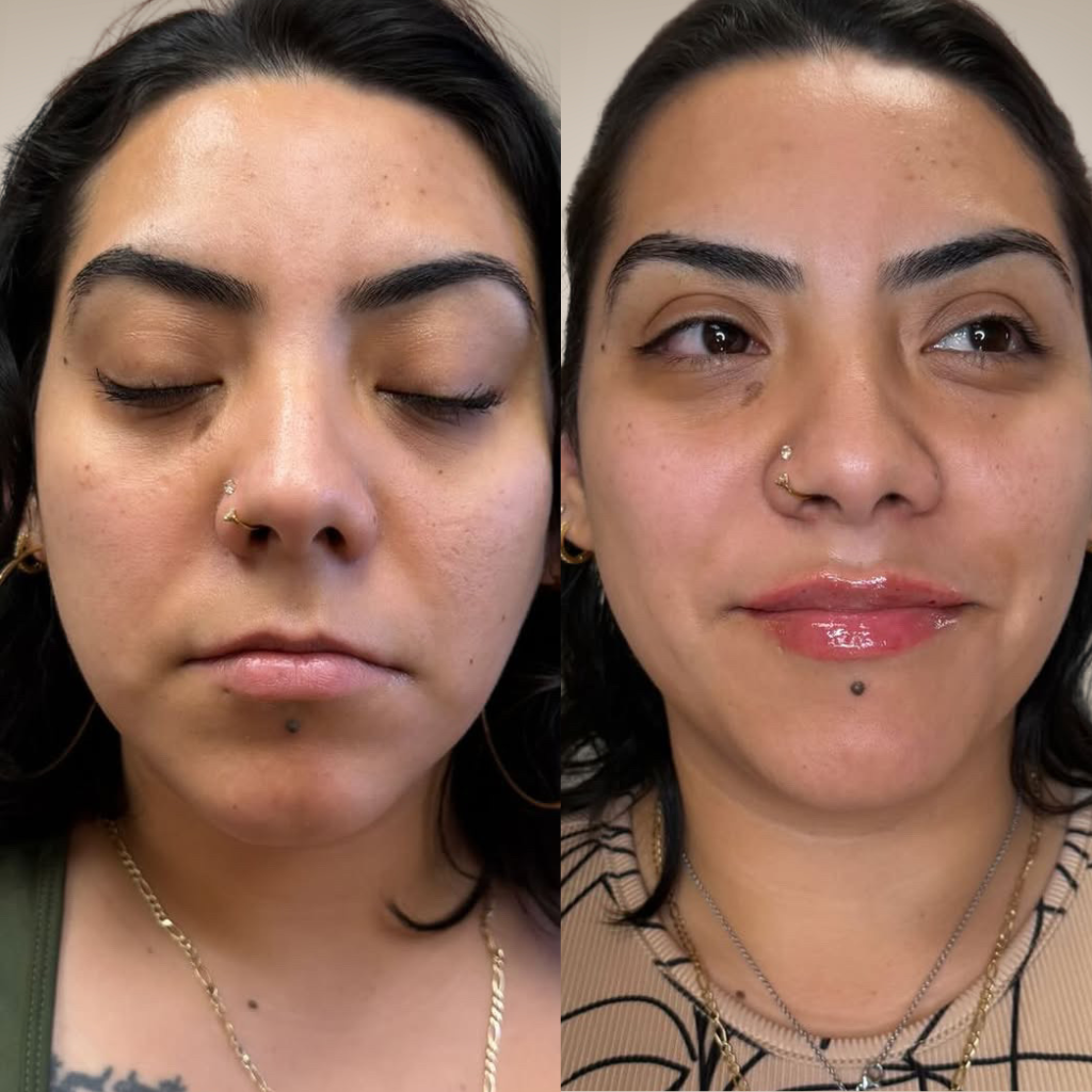before-and-after-lip-filler-thin-lips-natural-result.png